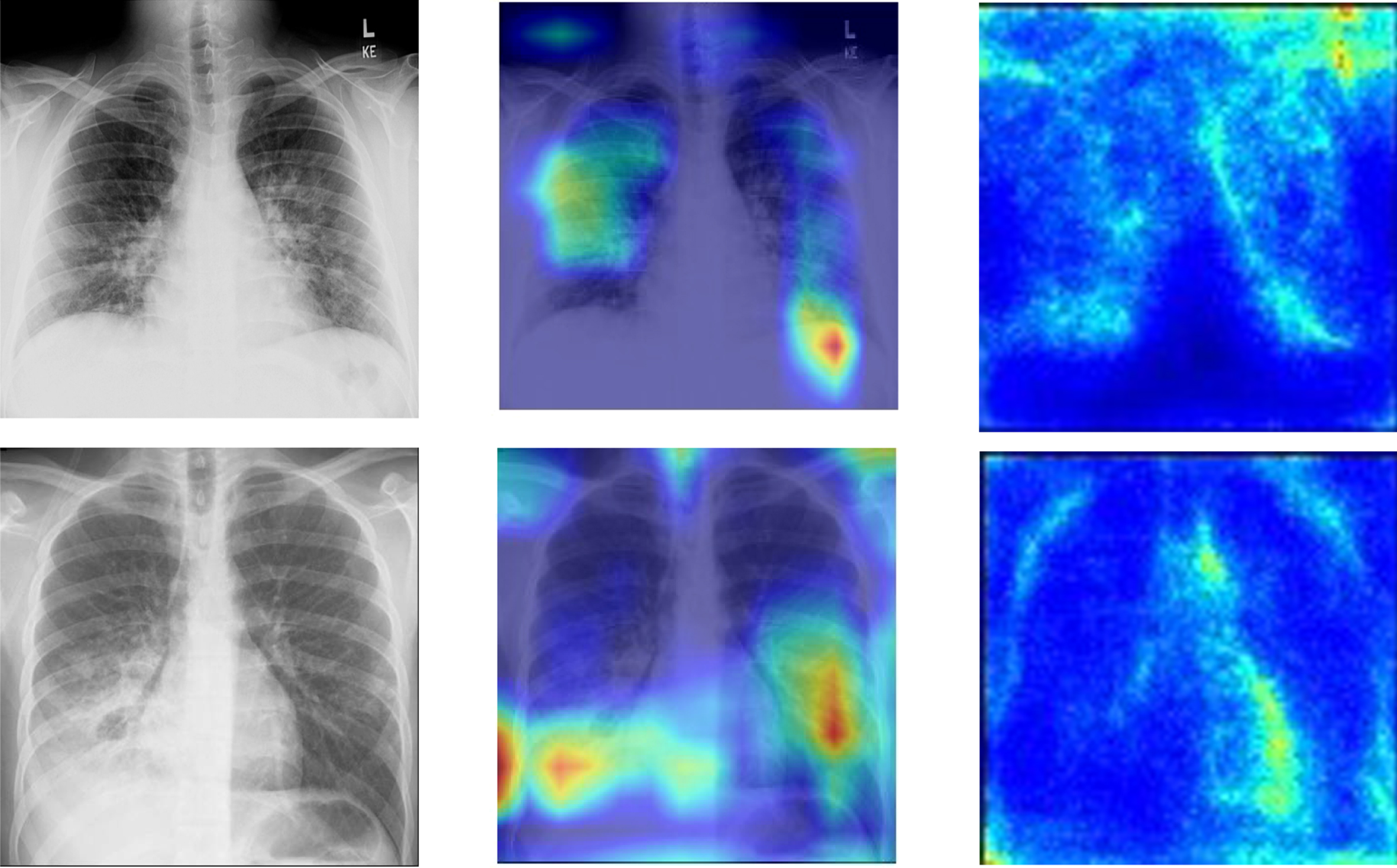 Graphical depiction of features extracted by network: Original CXR, Heat Map and Saliency Maps.