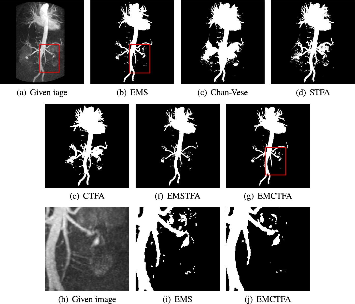 Example 4. CE-MRA image of abdominal vascular system extraction. (a) Given image; (b)–(e) Results by EMS, STFA, Chan-Vese, CTFA and EMSTFA methods, respectively; (g) Results of our EMCTFA method; (h)–(j) are the zoomed-in red rectangular parts of (a), (b) and (g).