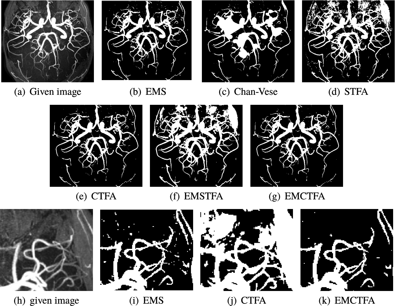 Example 5. TOF-MRA Circle of Willis Inverted MIP of carotid vascular system extraction. (a) Given image; (b)–(f) Results by EMS, Chan-Vese, STFA, CTFA and EMSTFA methods, respectively; (g) Results of the presented method; (h)–(k) are the zoomed-in parts of (a), (b), (d) and (e).