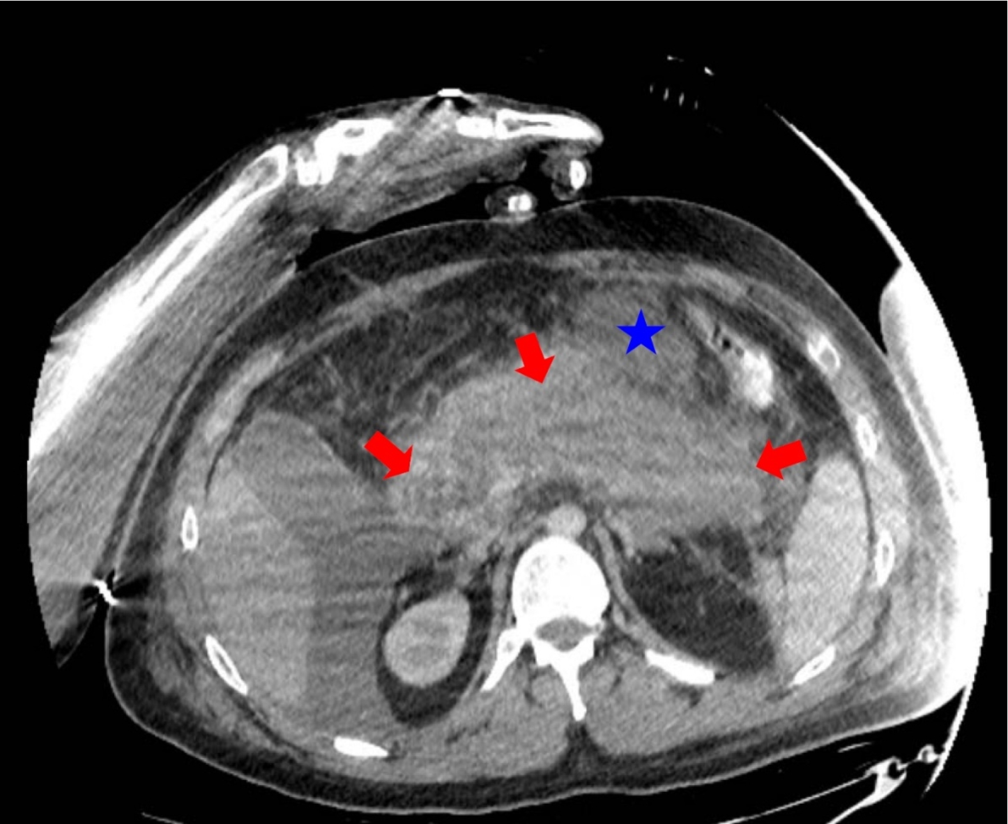 28 years old male with severe acute pancreatitis. Contrast-enhanced CT (portovenous phase, the same axial plane as on CEUS image) confirmed acute necrotizing pancreatitis (arrows) with acute necrotic collection (star).