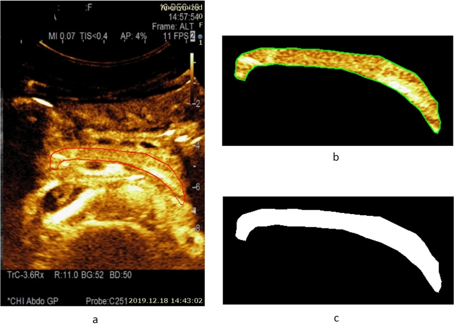Example of a CEUS image (15 s after injection of contrast agent) of a healthy pancreas (healthy volunteer – female) and estimated area of a healthy parenchyma (according to the presence of perfusion): a – contrast harmonic image of the pancreas region and manually selected ROI according to the solid red line, b – extracted informative ROI for further automatic detection of healthy parenchyma areas being marked with a solid green line, c – automatically detected area of a healthy parenchyma is binary marked (white) and covers 100.0% of the overall pancreas ROI.