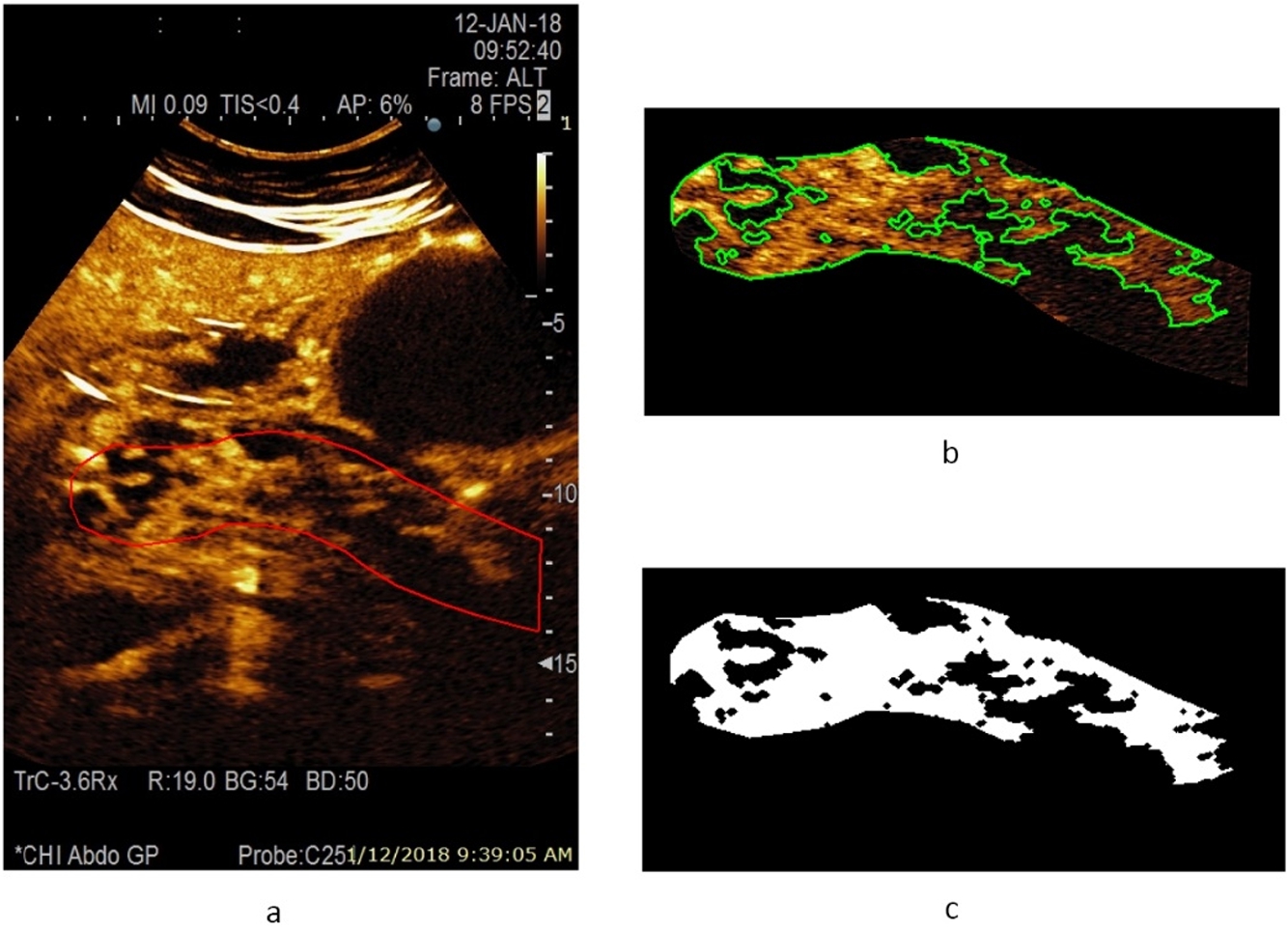 A CEUS image of a pancreas at 22 s after injection of contrast agent, and estimated area of a healthy parenchyma (according to the presence of perfusion) from a male patient with acute necrotizing pancreatitis: a – contrast harmonic image of the pancreas region and manually selected ROI marked with a solid red line, b – extracted informative ROI for further automatic detection of healthy parenchyma areas marked with a solid green line, c – automatically detected area of a healthy parenchyma (white colour) covering 55.6% of overall pancreas ROI.