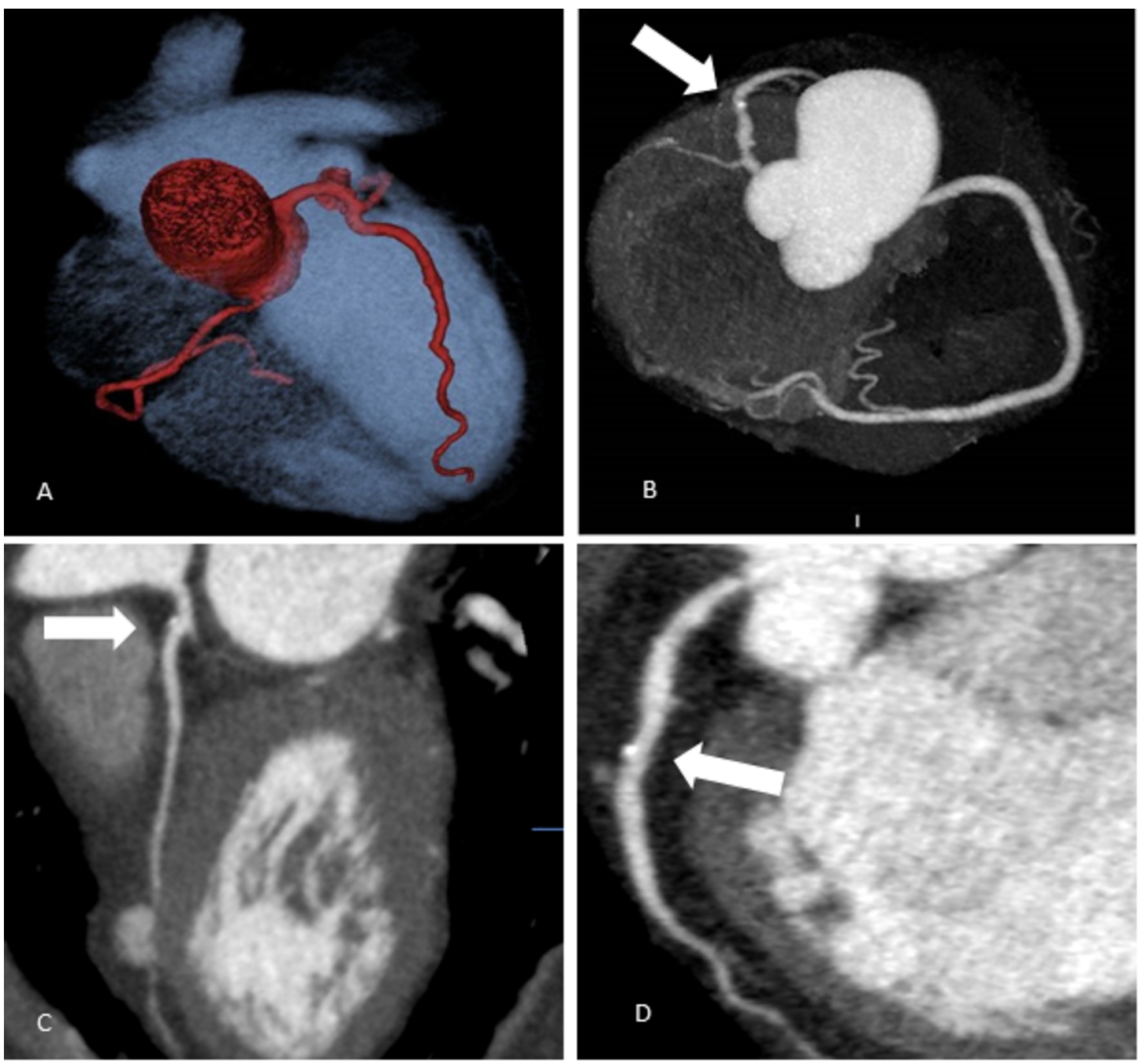 Coronary arteries’ scanning images (Group 1 – overweight patients).A – Coronary arteries’ 3D reconstruction. Patient’s BMI 29.1 kg/m2; 80-kV, effective dose 1.2 mSv.B – Coronary arteries’ 3D reconstruction. Patient’s BMI 25.1 kg/m2; 80-kV, effective dose 0.95 mSv; calcified plaque in LAD S6 (labelled by white arrow).C – Multiplanar curved reconstruction of LAD coronary artery. LAD S6 mixed plaque, 20% stenosis (labelled by white arrow). Patient’s BMI 28.2 kg/m2, 100-kV.D – Multiplanar curved reconstruction of LAD coronary artery. LAD S7 calcified plaque, 25% stenosis (labelled by white arrow). Patient’s BMI 25.1 kg/m2, 80-kV.