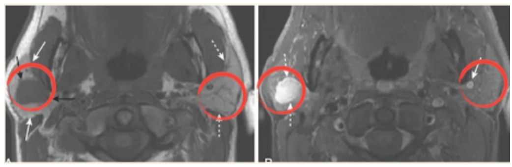 ‘Parotid pleomorphic adenoma’ detected in T1CE (right) instead of T1 (left).