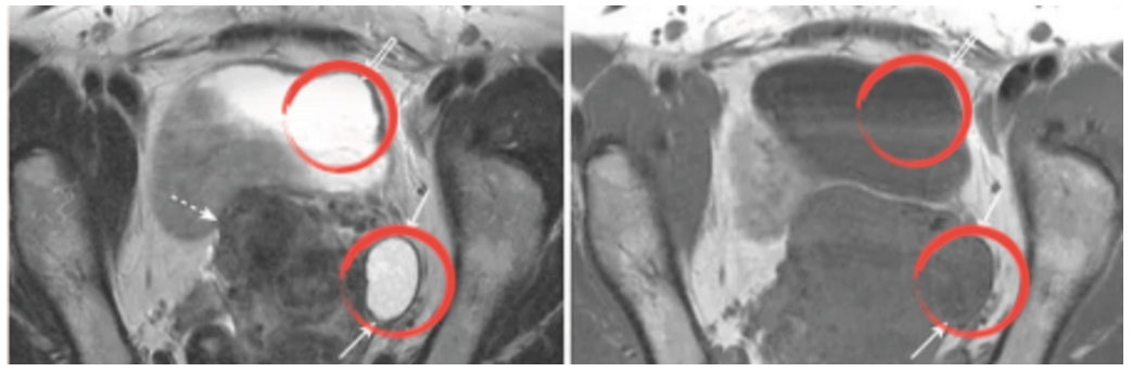 ‘Simple ovarian cyst’ detected in T2 (left) instead of T1 (right).