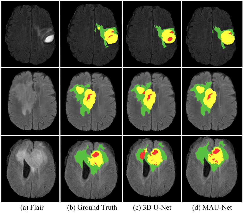 Visualization of segmentation results on the BraTS 2020 training set. WT contains red (labels 1), green (labels 2) and yellow (labels 4); TC contains red (labels 1) and yellow (labels 4); ET contains yellow (labels 4).