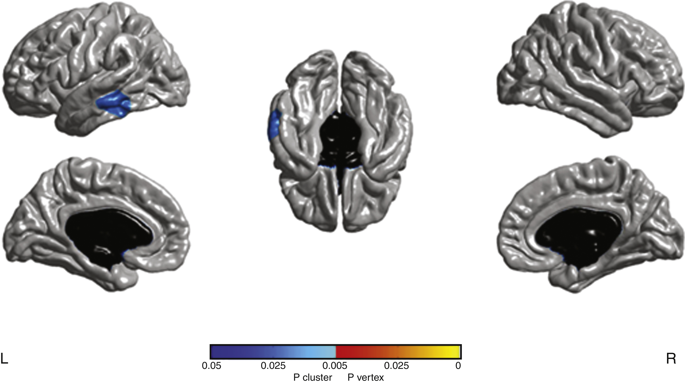 Cluster with significant cortical thickness changes in aGRN+ between the two time-points (p <  0.05 corrected). L, left; R, right.