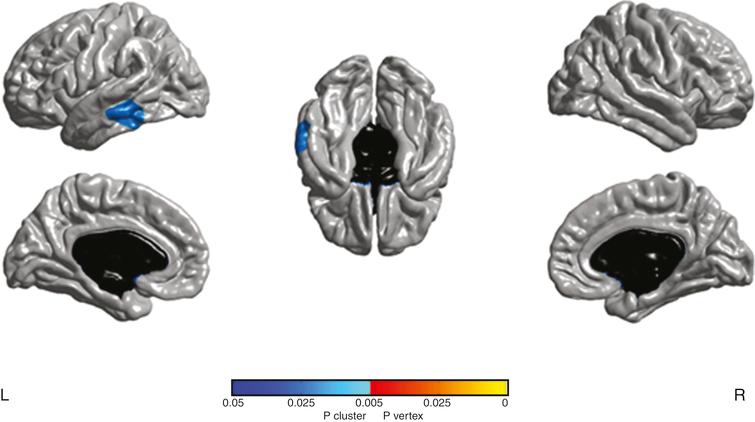 Cluster with significant cortical thickness changes in aGRN+ between the two time-points (p <  0.05 corrected). L, left; R, right.