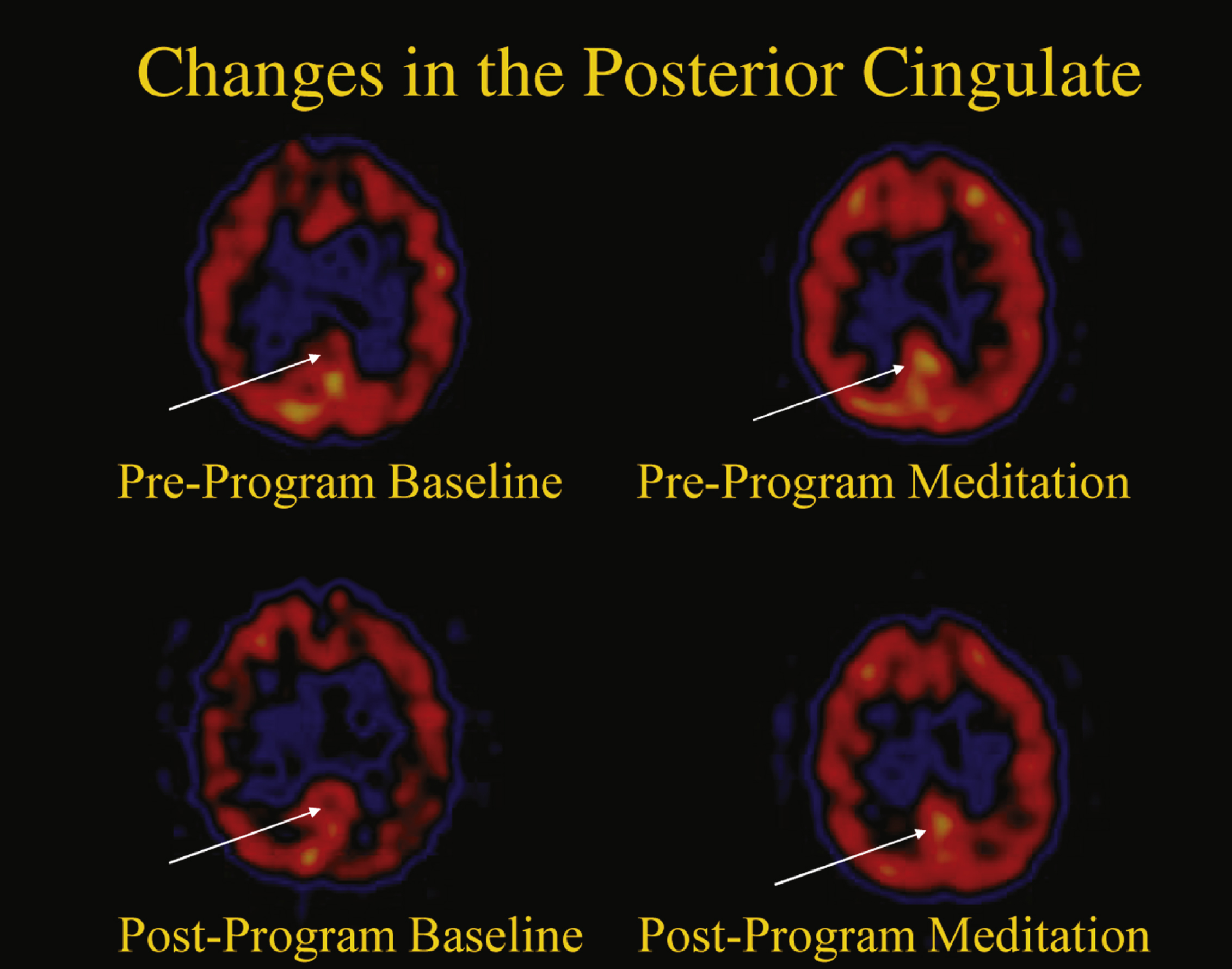Changes in the posterior cingulate gyrus.