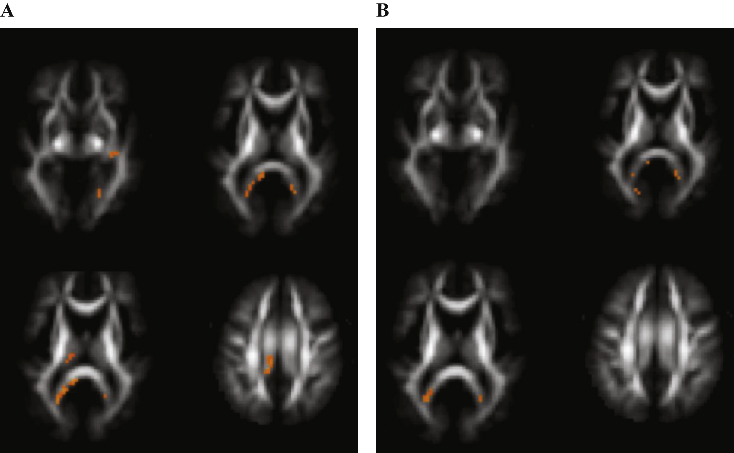 Voxels reaching statistical significance (p <  0.05) after FWE correction on whole-brain level for multiple comparison in Alzheimer’s disease versus control subjects at a cluster threshold of 20. No differences were found in fractional anisotropy. A) Regions with increased mean diffusivity. B) Regions with decreased mean kurtosis.