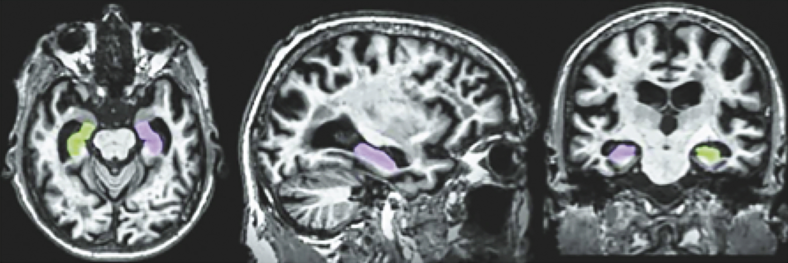 Color coded hippocampal image segmentation.