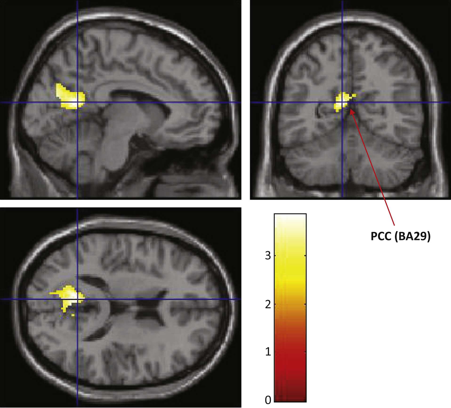 Analysis and location of longitudinal brain perfusion changes. Color indicates the brain region that showed a difference in brain perfusion changes between the two groups, after repeated two-way ANOVA, interaction Time×Variant (active > placebo, p < 0.01, Voxel threshold > 500). Due to low image quality, we eliminated one individual from the ACS group; therefore, we compared 38 participants in the ACS (n = 18) and placebo (n = 20) groups. Inverse calculation showed no plot. The locations are plotted on a template human brain. Red arrows with PCC (BA29) shows a cluster of perfusion preservation after supplementation (Cluster Size: 797; Peak (x, y, z) = (–8, –58, 16) at Z-score of 3.51).