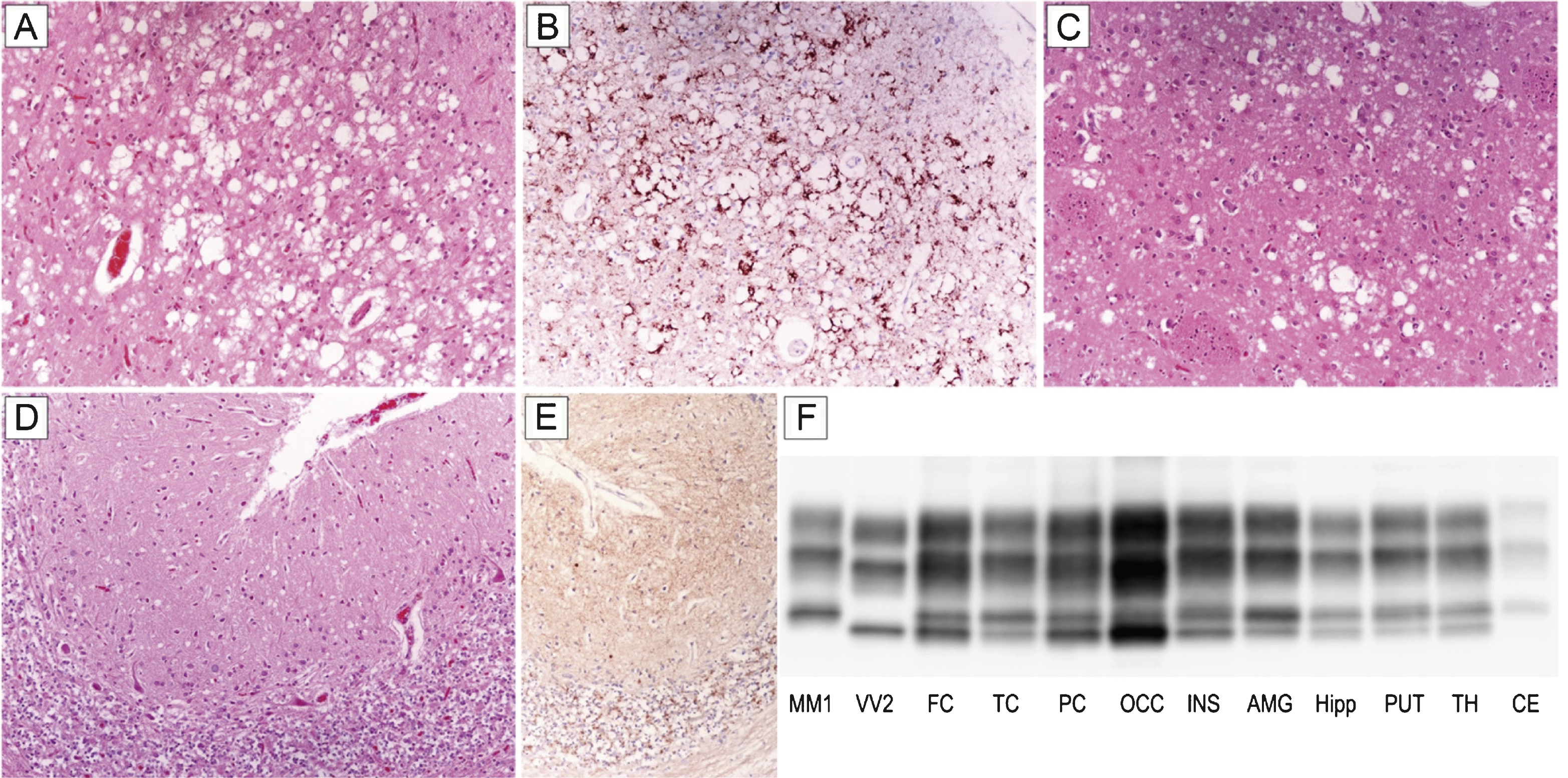 Distinctive histopathology and regional distribution of PrPSc in patient #16 (MM 2C+1). (A) Spongiform change characterized by large, confluent vacuoles (H&E stain) and (B) perivacuolar and coarse PrP deposits (PrP immunohistochemistry) in the occipital cortex; (C) mixed type of spongiform change with large, confluent vacuoles intermixed with smaller vacuoles in the striatum (H&E stain); (D) spongiform change characterized by small, fine, microvacuoles (H&E stain) and (E) synaptic pattern of PrP deposition in the cerebellum (PrP immunohistochemistry). All pictures (A-E) have the same magnification (×100); F) PrPSc typing by western blot showing the co-occurrence of protein types 1 and 2 in all regions but the cerebellum, where only a relatively low amount of type 1 is seen. While the amount of PrPSc type 2 is higher than that of type 1 in most samples from the cerebral cortex, subcortical gray matter structures show either a similar amount of the two proteins or a predominant accumulation of type 1.