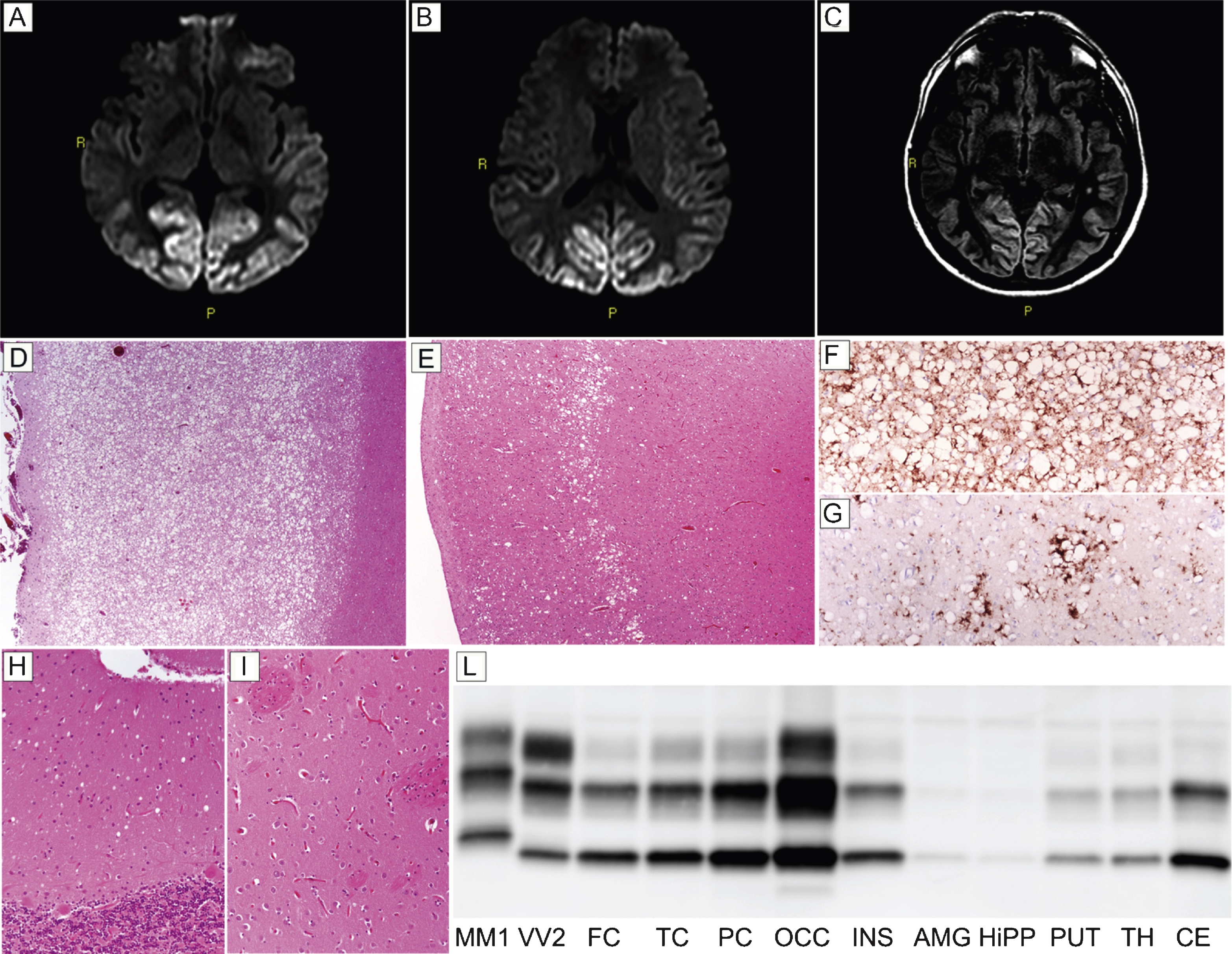 Results of neuroimaging, histopatological, and PrPSc studies in patient #18 (MM 2C). Hyperintensity of occipital cortex in DW- (A and B) and FLAIR- (C) sequences. (D) Spongiform change characterized by large, confluent vacuoles diffusely involving the gray matter (H&E stain, occipital cortex); (E) sparse foci of spongiform change especially involving the middle layers (H&E stain, frontal cortex); (F) perivacuolar pattern of PrP deposition in the occipital cortex; (G) sparse foci of coarse PrP deposits in the frontal cortex; (H) mild spongiform changes characterized by small vacuoles in the cerebellum (H&E stain); (I) lack of significant spongiform change in the putamen (H&E stain). Pictures (D-I) in the panel have the same magnification (×100). (L) PrPSc typing by western blotting revealing a type 2 pattern of electrophoretic mobility in all regions; PrPSc is overall more abundant in the cerebral cortex (especially in occipital cortex) than in subcortical areas where only traces or a relatively low amount of the abnormal protein are detected.