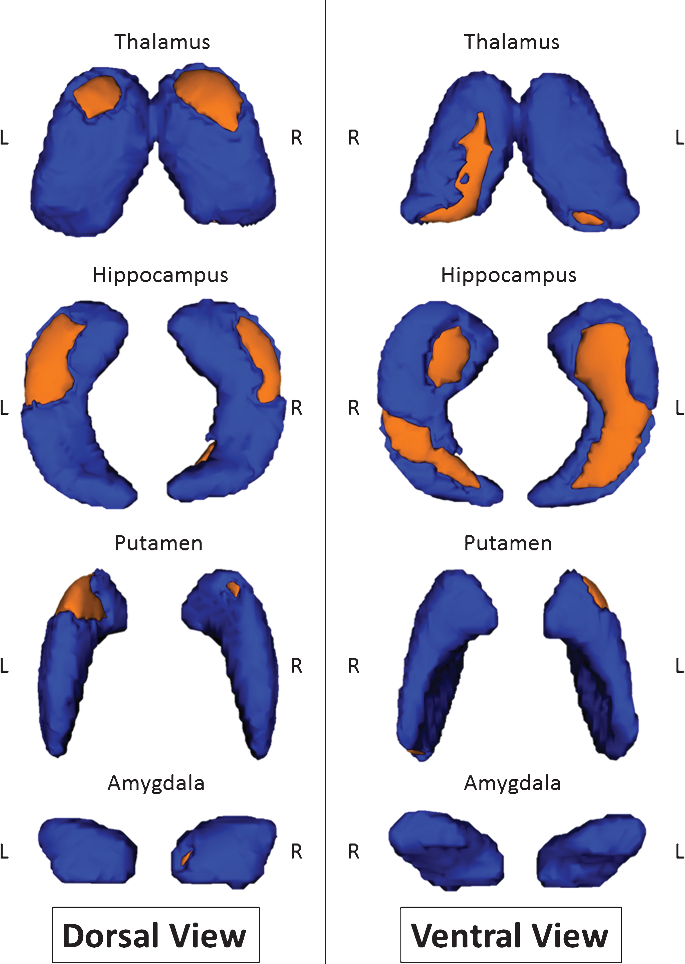 Shape modifications between MCI-due-to-AD patients and healthy controls in dorsal and ventral views. Areas in orange represent localization with significant shape modification (p <  0.05 corrected for multiple comparisons).