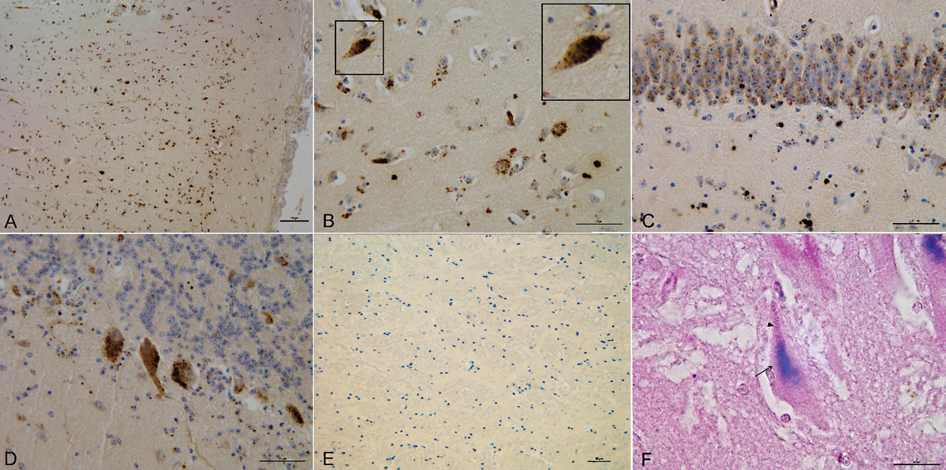 IHC and IHC: HC immunoreactive deposits in different brain areas. A) 4G8-deposits in the frontal cortex. Bar = 250 μm. B) 4G8-deposits in the frontal cortex (Bar = 50 μm) with magnification of intraneuronal localization (100x). C) 4G8-deposits in the hippocampus. Bar = 50 μm. D) 4G8-deposits in the cerebellum. Bar = 50 μm. E) Absence of 4G8-deposits in the brainstem. Bar = 50 μm. F) IHC: HC, 4G8-deposits (arrow) and lipofuscin (arrowhead) in the frontal cortex. Bar = 20 μm.