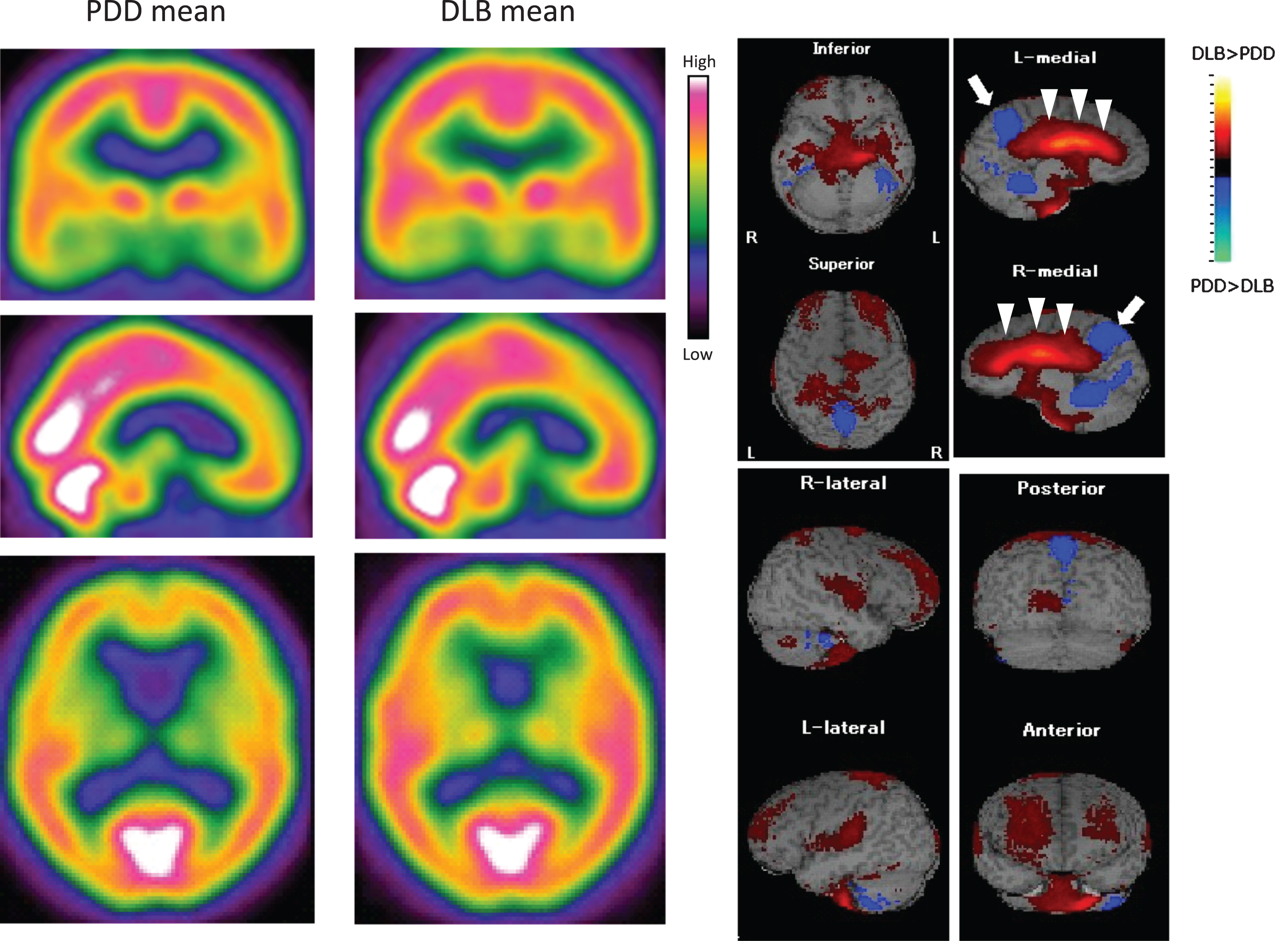 99mTc-ECD SPECT images of the mean values in PDD and DLB patients (left panels). There is a slight decrease of CBF in the frontal lobe in PDD, but similar CBF levels in the posterior lobes of both PDD and DLB. Subtraction image of mean PDD –mean DLB (right panels), showing a higher CBF in whole cingulate gyrus in DLB than PDD groups (arrowheads), and a lower CBF in the precuneus area in DLB (arrow) than PDD.