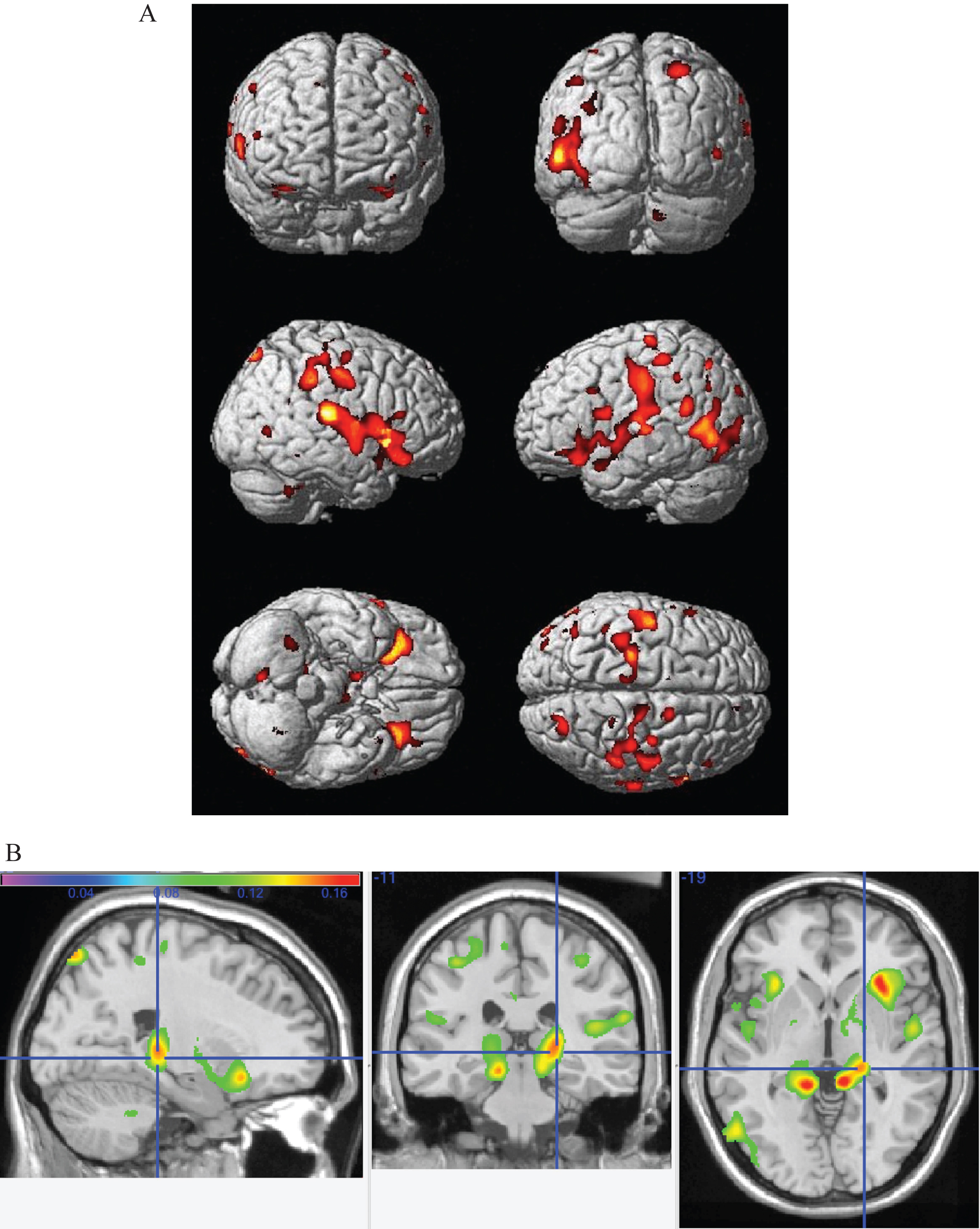 A) Main effect of increasing caloric expenditure on gray matter structure in the CHS. Red and yellow colors reflect larger gray matter volumes in the frontal, temporal, and parietal lobes with FDR <0.05. B) The main effects from panel A overlayed onto orhtogonal slices. Hotter colors denote a stronger effect and the cross hairs highlight the main effect of physical activity in the right hippocampus.