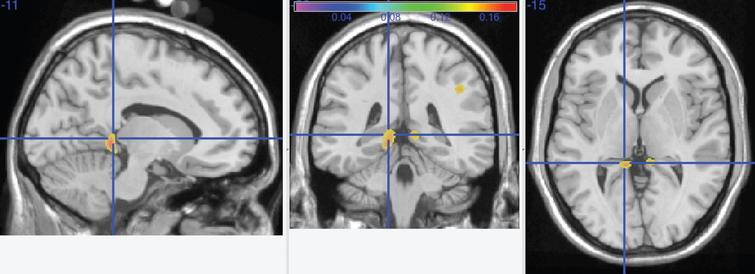 Main effect of the top quartile of physical activity as assessed by the top quartile of kcal measurements. The crosshairs point to a cluster of voxels denoting higher gray matter volumes in the top quartile group in the left precuneus, extending into the left lingual gyrus.A smaller cluster is seen in the same regions on the right lingual gyrus and precuneus.