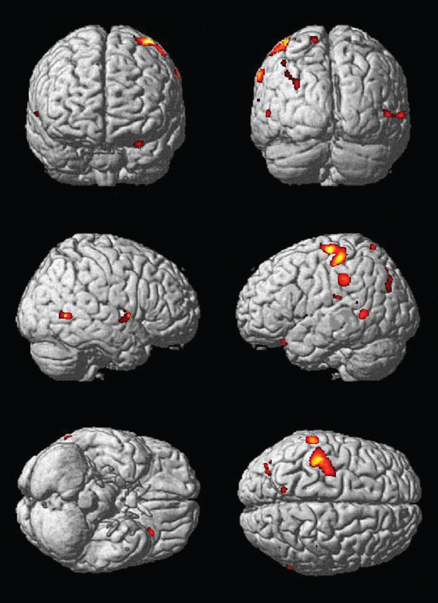 Main effect of change in physical activity over time on gray matter structure. Areas that demonstrated more gray matter volume with increased physical activity over time include the left inferior orbital frontal cortex (–29, 25, –23) and left precuneus (–13, –63, 71).