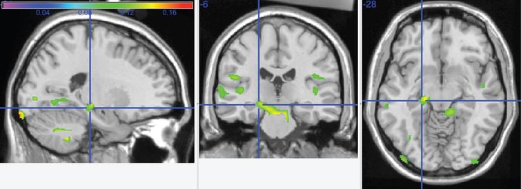 This graphic shows the interaction between increasing caloric expenditure and cognitive impairment (MCI or AD) overlayed onto the left hippocampus (crosshairs) and cerebellar vermis.