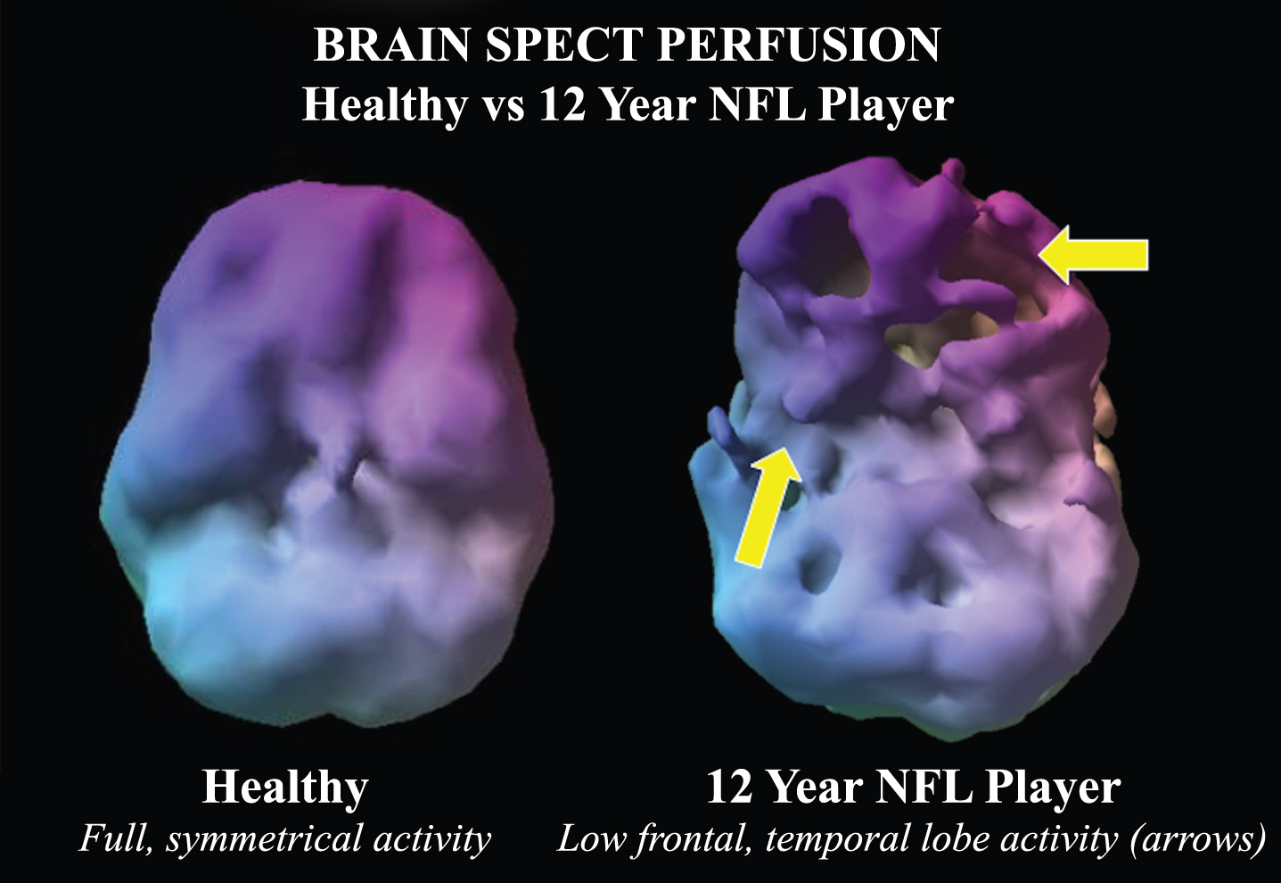Example of a volume rendered of the undersurface of the brain in normal control compared to a 12-year NFL player. While the control subject has symmetric activity, the NFL player has multiple defects in the inferior frontal and temporal lobes suggestive of concussion related hypoperfusion.