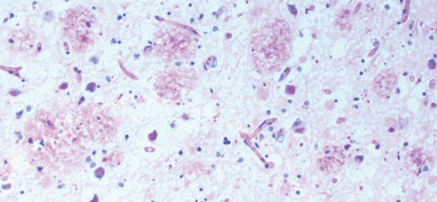 Hippocampal plaques consisting of biofilms. AD brain plaques: polysaccharides of biofilms stain pink with PAS. PAS 10X. From Allen et al. [8].