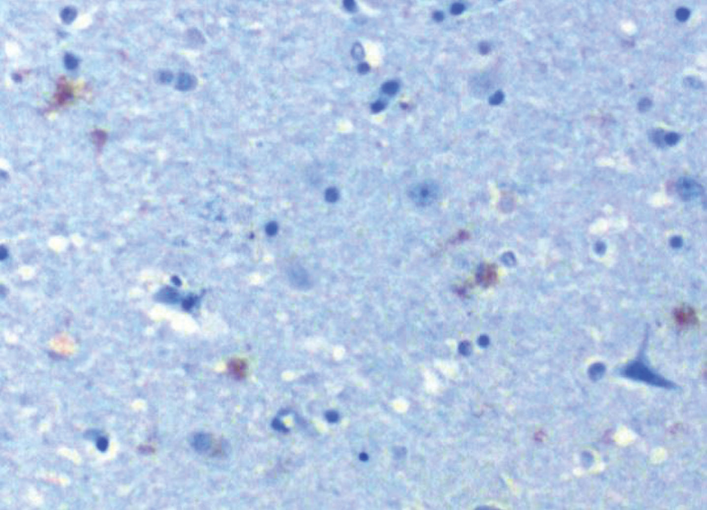 TLR 2 in hippocampus of AD patient. TLR 2 (CD 282) stains brown (represents activation) 10X. From Allen et al. [8].