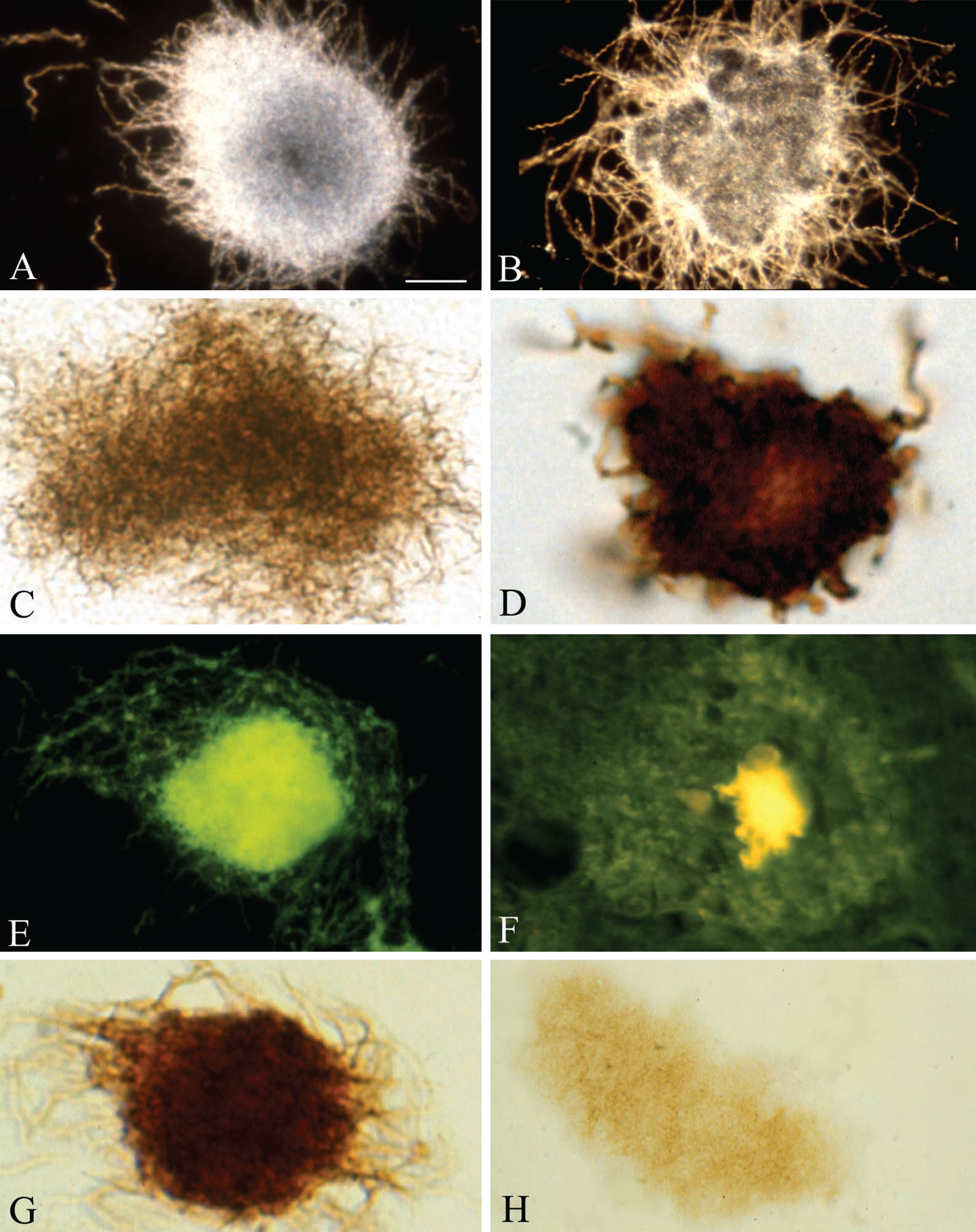 Pure in vitro B. burgdorferi biofilms contain Aβ an important component of senile plaques. A, B) Dark field microscopy images of pure B. burgdorferi biofilms of reference strain B31 cultivated from infected tick (A) and strain ADB1 cultivated from the brain of an AD patient with confirmed chronic Lyme neuroborreliosis (B). C) Pure B. burgdorferi biofilm of strain ADB2 stained with Warthin and Starry silver technique for the detection of spirochetes. D) Pure B. burgdorferi biofilm of strain ADB2 immunostained with anti-OspA monoclonal antibody exhibiting positive immunoreaction. E) Green thioflavin S fluorescence of in vitro formed B. burgdorferi biofilm of strain ADB2. F) Thioflavin S fluorescence of a senile plaque in the frontal cortex of an AD patient where B. burgdorferi ADB2 strain was cultivated from the brain. G) In vitro formed B. burgdorferi biofilm (strain B31) immunoexpressing AβPP; H) In vitro B. burgdorferi biofilm of strain ADB1 exhibiting positive Aβ immunoreaction. Scale bar = A: 15 μm for A-C and E-H and 10 μm for D.