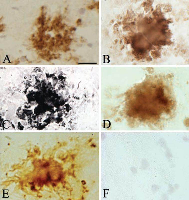Senile plaques contain spirochete-specific DNA. Photomicrographs of spirochetal colonies or biofilms in an AD case with confirmed Lyme neuroborreliosis where B. burgdorferi spirochetes (ADB1) were cultivated from the brain. A) Positive Aβ immunoreaction of senile plaque. B) Senile plaque of the same AD case, as in A, exhibiting strong immunoreaction for bacterial peptidoglycan. C, D) Photomicrographs showing B. burgdorferi antigens in senile plaques immunostained with a polyclonal anti-B. burgdorferi antibody (C) and with a monoclonal anti-OspA antibody (D). E) B. burgdorferi specific DNA detected by in situ hybridization in senile plaque of an AD patient where ADB1 strain was cultivated. F) Cortical section of a control case immunostained with a monoclonal anti-OspA antibody showing no immunoreaction. Scale bar = A-E: 40 μm, F = 25 μm. Photomicrograph E is a reproduction of Fig. 2b of [7].