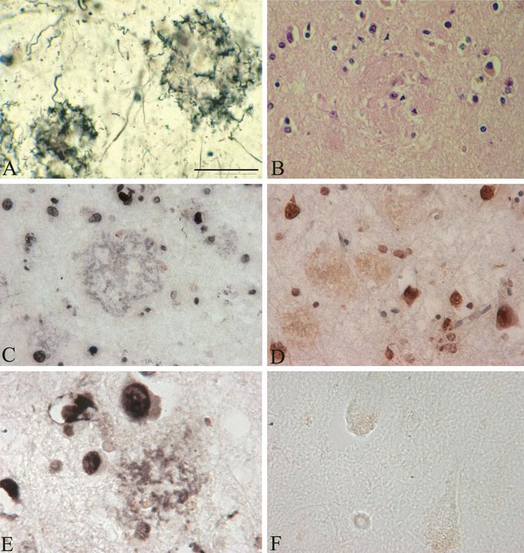In situ DNA fragmentation in senile plaques using the terminal deoxynucleotidyltransferase-mediated dUTP nick end-labeling (TUNEL) assay. A) Senile plaques in an AD case where B. burgdorferi (strain ADB1) was cultivated from the brain. Frozen section stained with Maurer technique used for the detection of senile plaques in AD. B) Paraffin section stained with Haematoxylin and eosin, in the same case as in A, showing senile plaques in the frontal cortex. C-E) Frozen (C and E) and paraffin (D) sections from the frontal associative area (Brodmann’s area 8-9) of the AD case, where B. burgdorferi strain ADB2 was cultivated from the brain. The TUNEL assay demonstrates in situ DNA fragmentation in black (C and E) or in brown (D) color. The majority of cells showing apoptosis are large nuclei of neurons, but some glial cells also exhibit TUNEL positive nuclei. Scale bar = A-C: 150 μm, D: 200 μm, E, F: 80 μm.