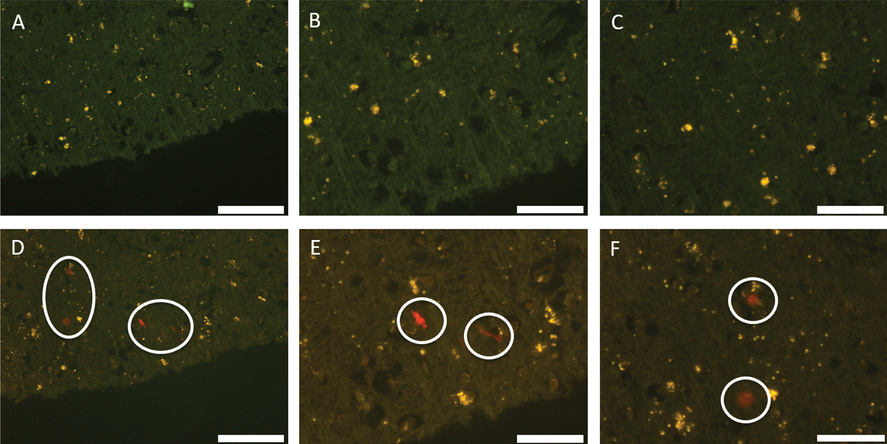 Autofluorescence (A–C) and fluorescence (D–F) images of occipital lobe stained with lumogallion. Significant deposits of aluminum showing strong positive fluorescence are circled. Scale bar is 100 μm (A and D) and 50 μm (B, C, E, F).