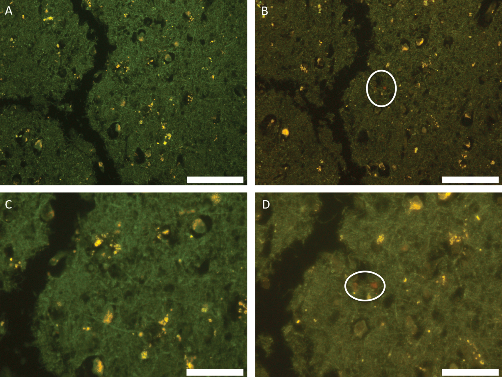 Autofluorescence (A, C) and fluorescence (B, D) images of temporal lobe stained with lumogallion. Deposits of aluminum showing strong positive fluorescence are circled. Scale bar is 100 μm (A, B) and 50 μm (C, D).