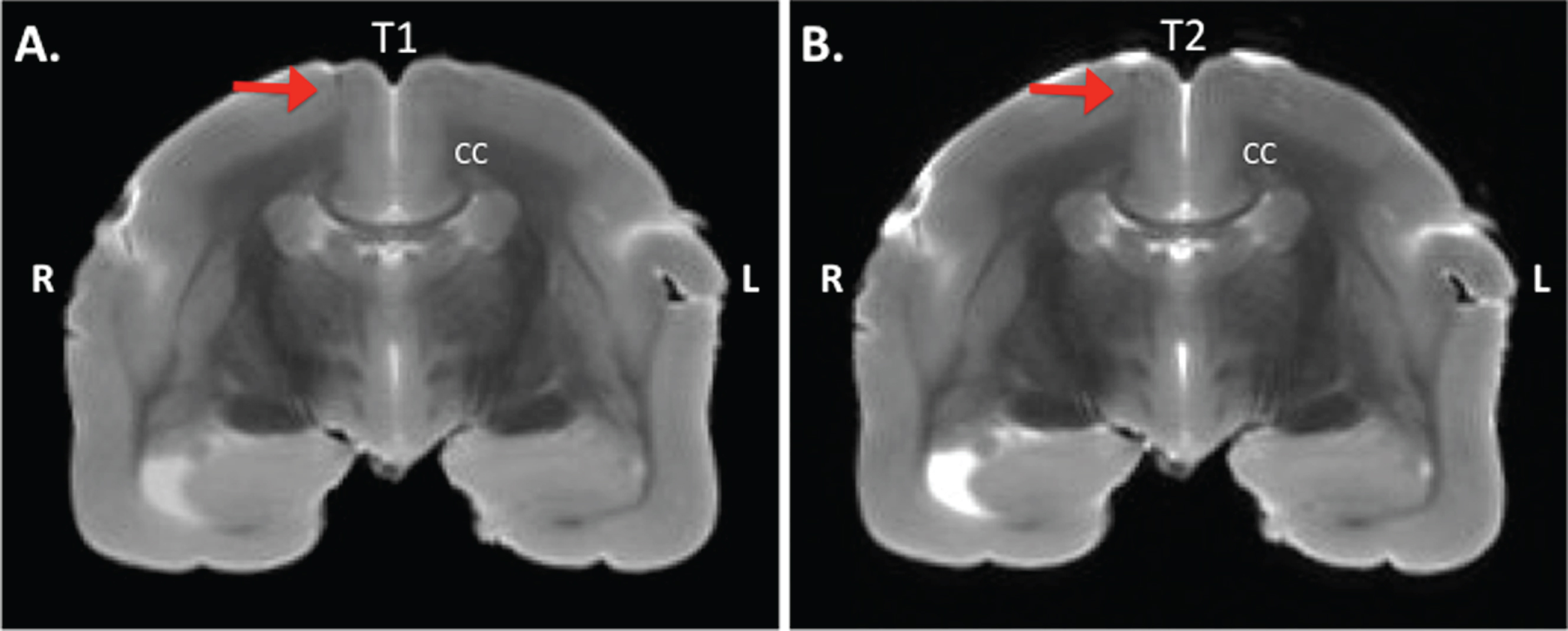 Postmortem MRI of a transcranial section of a marmoset brain. MRI is taken at +4 mm from Bregma on the anterior-posterior axis from an Aβ+LPS treated monkey. A) IR-RARE T1 weighed image, and B) TurboRARE T2 weighed image. The red arrow indicates the location of injection. CC, corpus callosum; R, right; L, left.