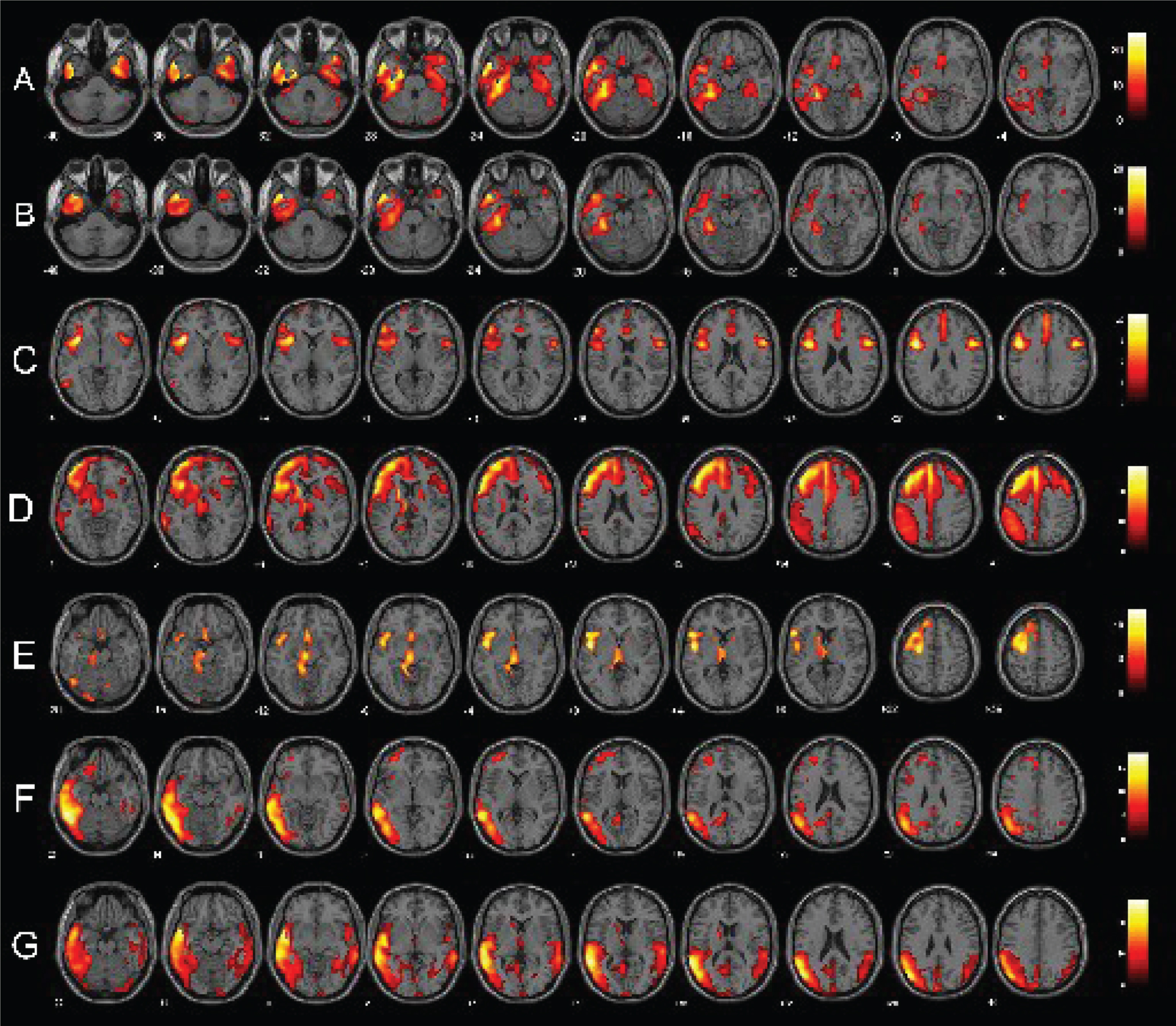 Single-subject FDG-PET SPM t-maps of PPA patients. Panels A and B show respectively a bilateral and a left-predominant pattern of anterior temporal hypometabolism in two sv-PPA patients. Panels C, D, and E represent respectively patterns of pure nfv-PPA, nfv-PPA classified as CBD and as PSP at the follow-up. Finally, panels F and G show lv-PPA with a left-predominant and a bilateral pattern of hypometabolism. FDG-PET SPM brain hypometabolism patterns are shown in axial view, p < 0.001 uncorrected.