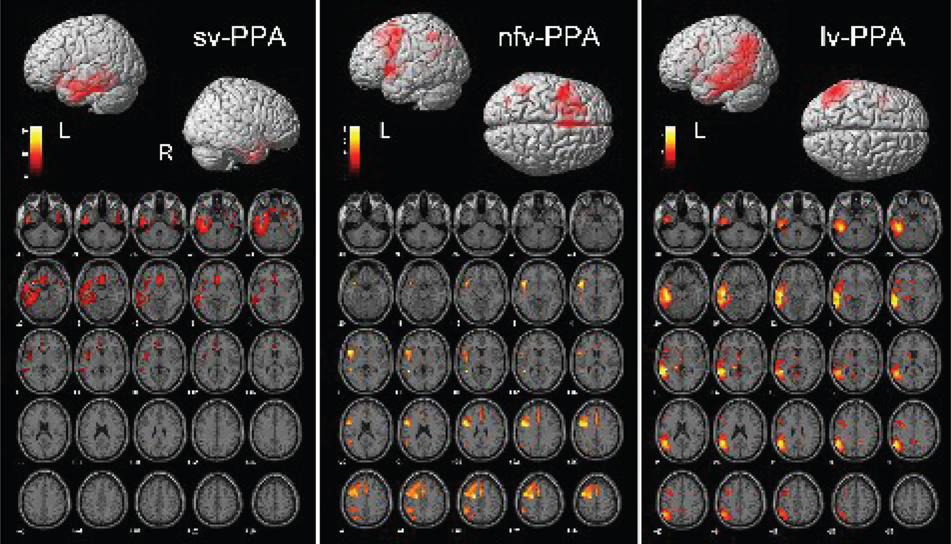 Brain regions showing significant FDG-PET hypometabolism in the primary progressive aphasia (PPA) variants. On the bottom side of each figure, the FDG-PET hypometabolic pattern resulting from the one-sample SPM group analysis is shown in axial view (x = [–40:+56]; p < 0.001 uncorrected). On the upper side of each figure, left (L) and right (R) renders are shown. See text for details of the involved brain regions.