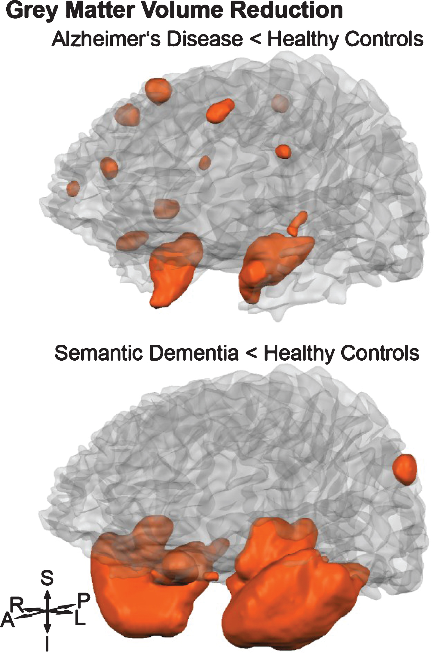 Orange shaded areas visualize grey matter volume reductions (p < 0.05 family-wise error rate corrected) of Alzheimer’s disease and semantic dementia groups compared to healthy controls. S, superior; P, posterior; L, left; I, inferior; A, anterior; R, right.