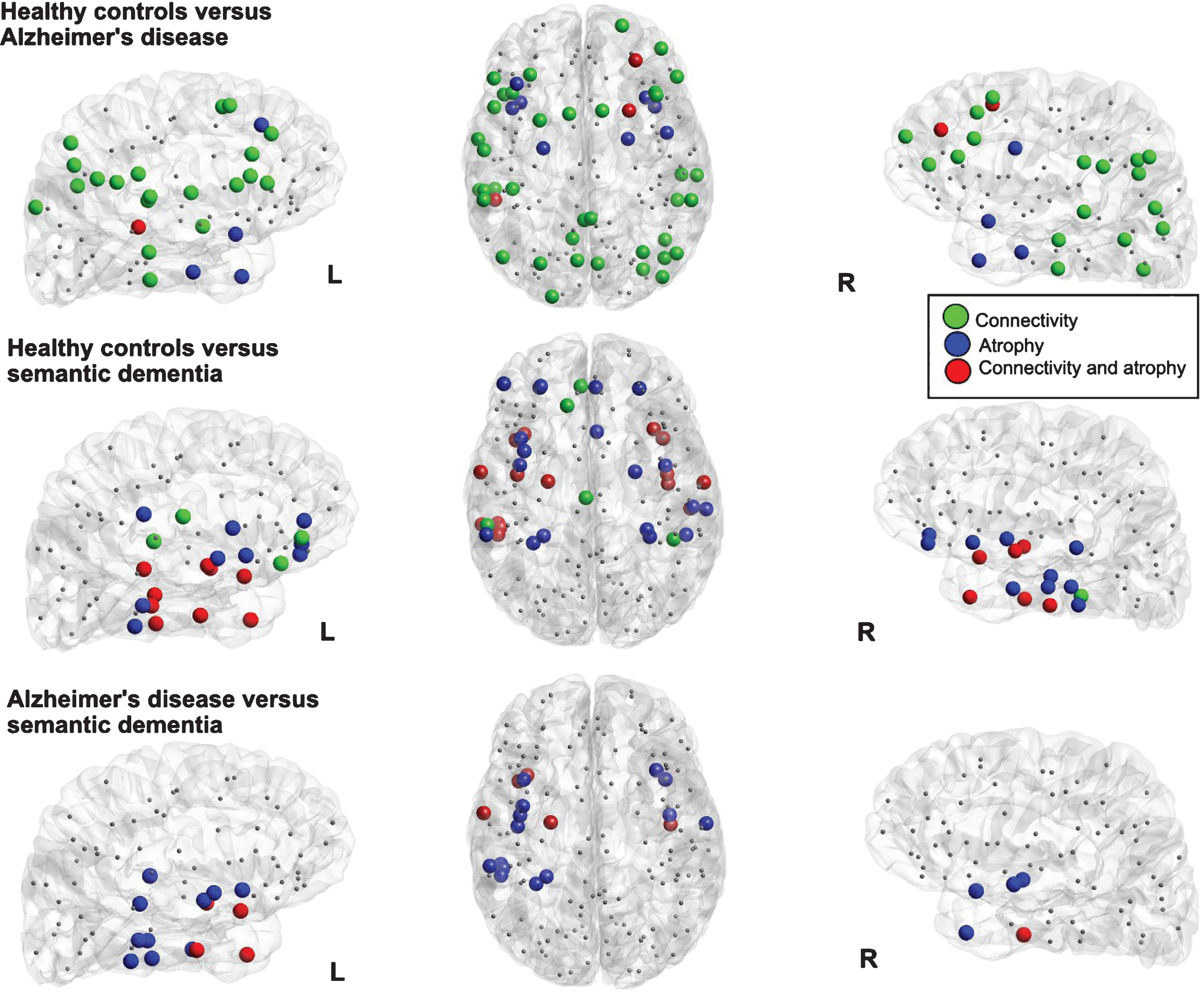 Visualization of the local differences in the cortical networks of healthy controls versus Alzheimer’s disease (top row) and healthy controls versus semantic dementia (bottom row). Colored nodes indicate significant differences in connectivity strength (green nodes), grey matter volume (blue nodes, significant difference in at least 50 voxels and >1% of the region), or both (red nodes).