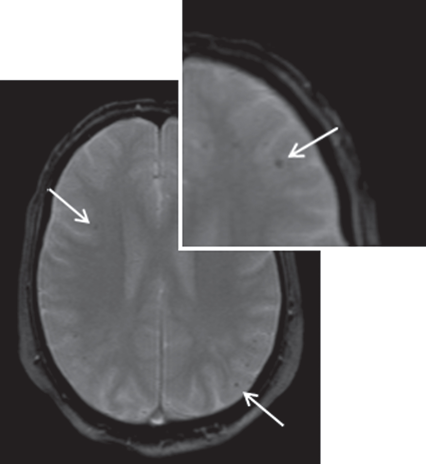 Baseline MR imaging of subject II.6. Cerebral MRI imaging of subject II.6 at age 70 showing several microbleeds (arrows). T2 weighted image.