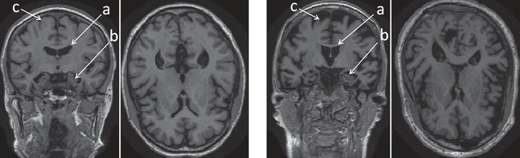 Overall tissue loss in the brain in AD patient (right) versus normal control (left) in coronal and axial views. The labeled regions are: (a) lateral ventricles; (b) hippocampi; and (c) cerebral cortex.