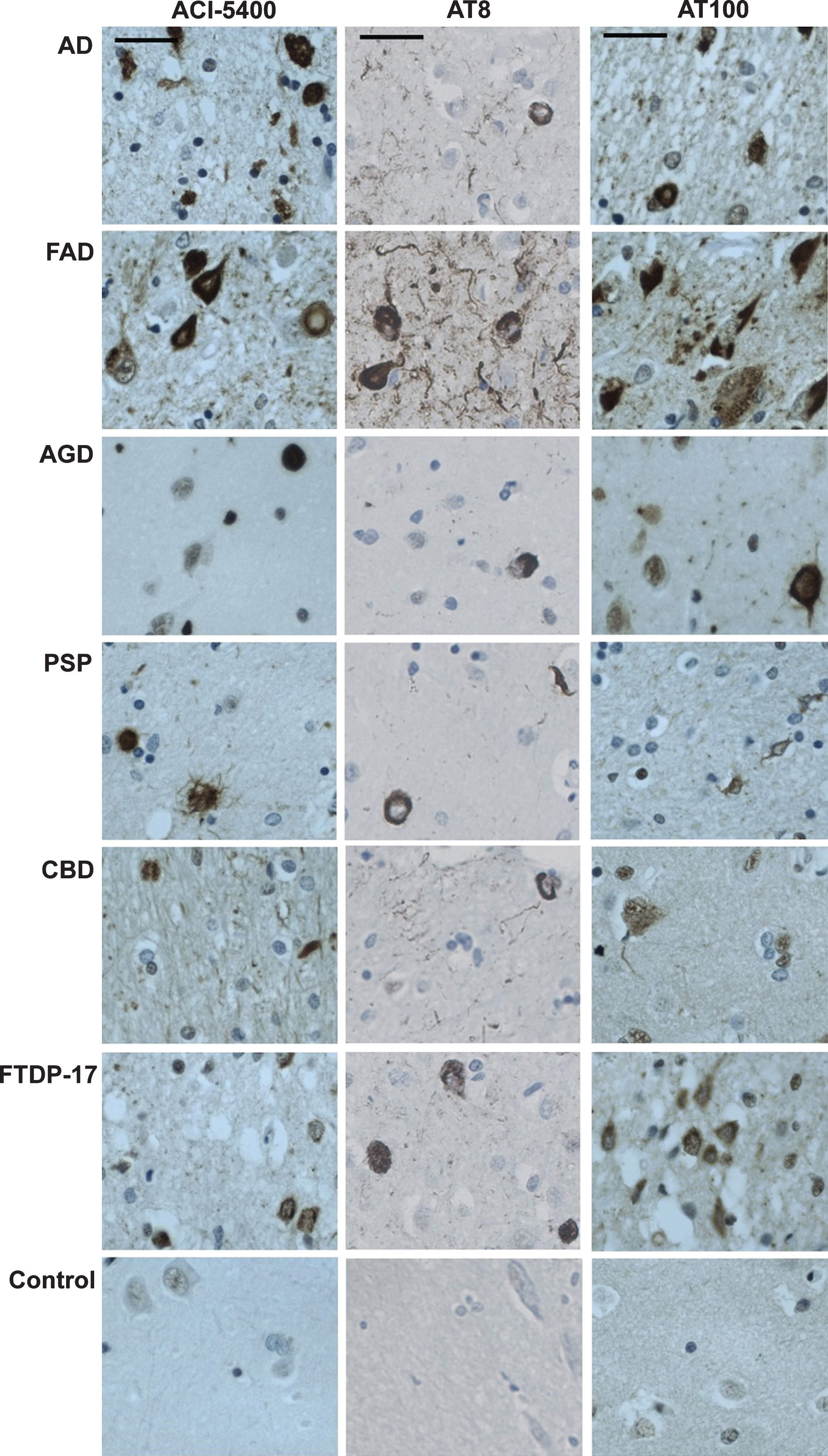 ACI-5400 specifically detects Tau pathology in clinically different tauopathies. IHC with ACI-5400 revealed aggregated Tau inclusions specific for the different tauopathies (left column), denoted by standard abbreviations in the captions on the left (n = 1). Parallel analysis with Mabs AT8 (central column) and AT100 (right column) were done as positive controls. The following antibody dilutions were used: ACI-5400 at 1/3’000, AT8 at 1/3’000, and AT100 at 1/100. Scale bars = 40 μm.