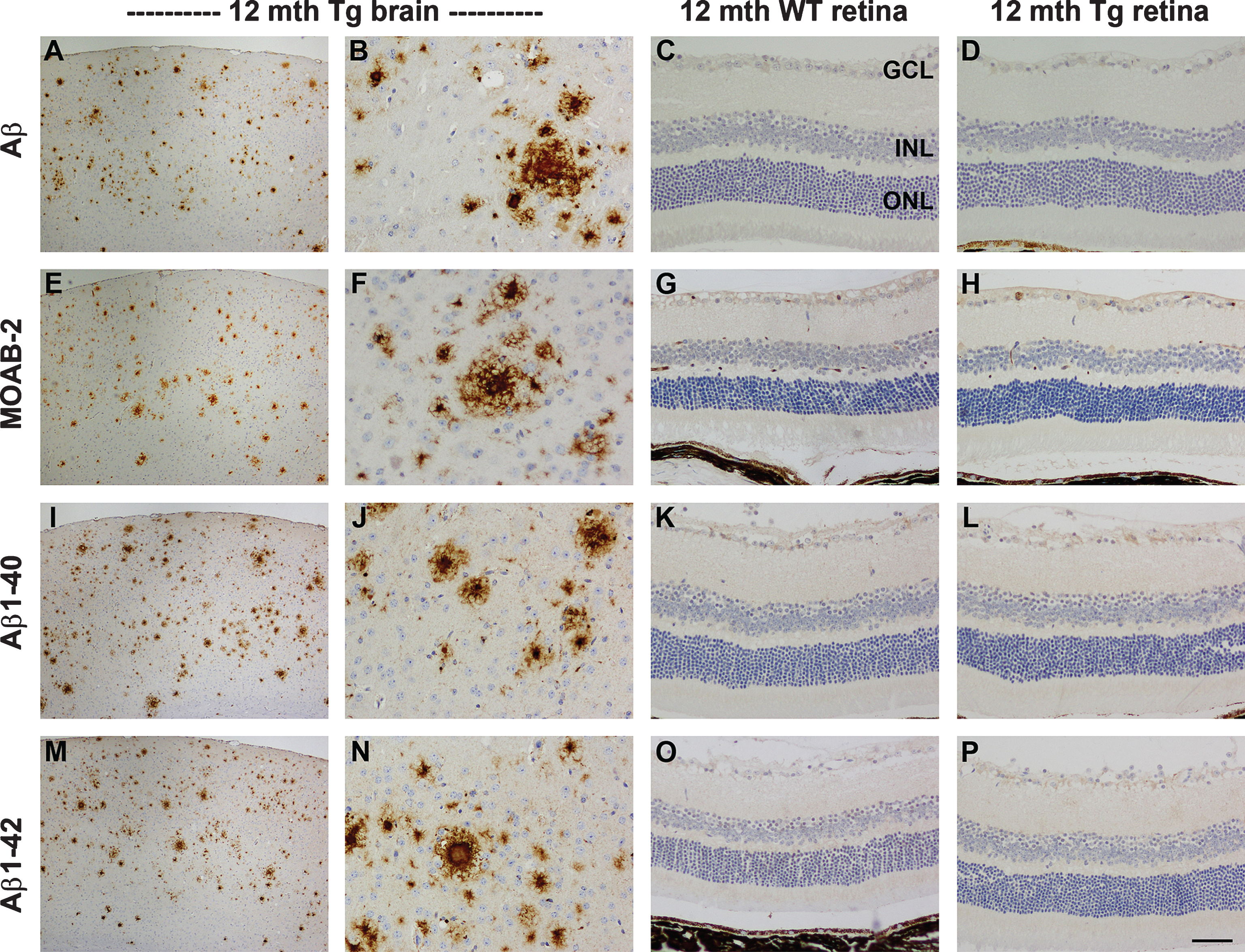 Representative images of Aβ, MOAB-2, Aβ1 - 40, and Aβ1 - 42 immunolabeling in the brain and retina of 12-month-old WT and Tg mice. In Tg parietal cortex (A, B, E, F, I, J, M, N) amyloid plaques are abundant. All four antibodies display high signal-to-noise ratios. In contrast, no amyloid deposits are evident in sections of WT (C, G, K, O) or Tg (D, H, L, P) retinas. Scale bar: A, E, I, M = 250 μm; B-D, F-H, J-L, N-P = 50 μm; GCL, ganglion cell layer; INL, inner nuclear layer; ONL, outer nuclear layer.