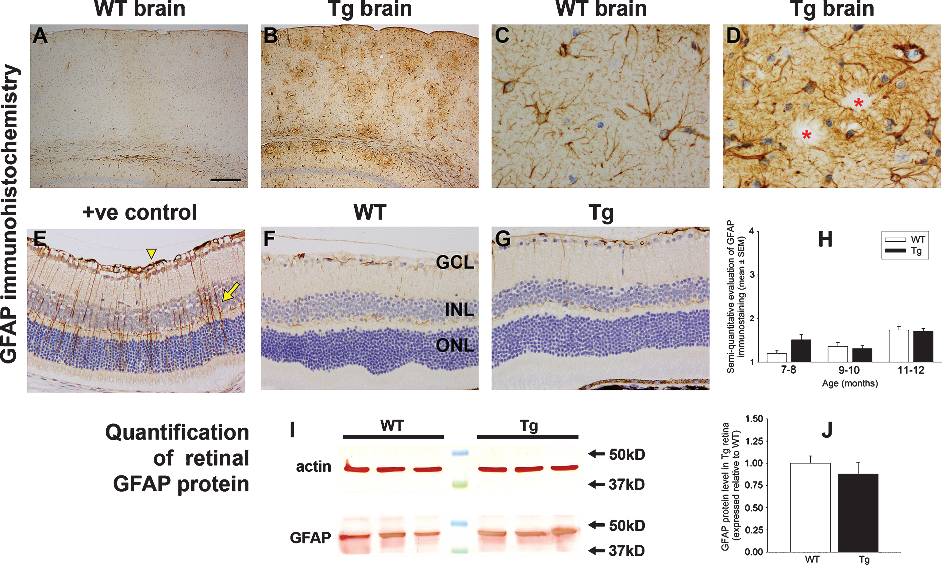 Analysis of GFAP expression in WT and Tg mice. Representative images of GFAP immunolabeling in 11-month-old WT and Tg parietal cortex (A, B) and hippocampus (C, D). In Tg brains, numerous GFAP-positive astrocytes are evident surrounding amyloid plaques, signified by red asterisks. E-G) Representative images of GFAP labeling in a retina subjected to branch retinal vein occlusion (BRVO, +ve control), and in 12-month-old WT and Tg retinas. GFAP immunoreactivity is chiefly restricted to astrocytes in the retinas of WT and Tg mice. In contrast, four days after BRVO, a substantial upregulation of GFAP is evident both in astrocytes (arrowhead) and Müller cells (arrow). Note: the area of retina shown is adjacent to the vein occlusion site and not directly affected. H) Semi-quantification evaluation of GFAP grade in WT and Tg retinas. Data are expressed as mean±SEM, where n = 10 for each age-matched group. Mann-Whitney test revealed no significant differences between the treatment groups. Scale bar: A, B = 250 μm; C, D = 25 μm; E-G = 50 μm. GCL, ganglion cell layer; INL, inner nuclear layer; ONL, outer nuclear layer. I, J) Expression of GFAP protein in 11–12-month-old WT and Tg retinas as evaluated by western immunoblotting. A single band of the expected molecular weight is apparent. Data (expressed as mean±SEM, where n = 10) are normalized for actin and expressed relative to WT. Student’s unpaired t-test revealed no significant difference between the treatment groups.