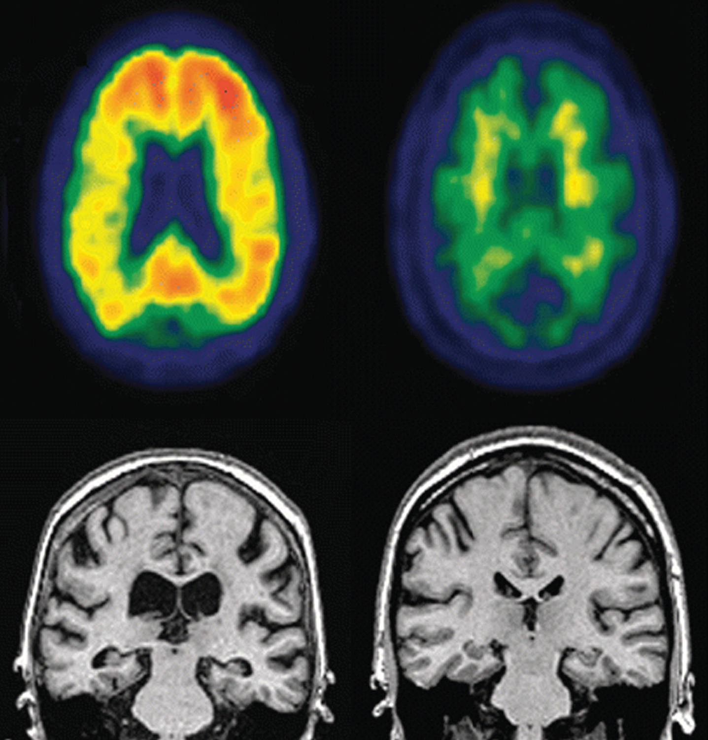 Representative PET (top row) and MRI (bottom row) images of an MCI individual that progressed to AD dementia (left) compared to an MCI individual who did not progress to AD dementia. Notice increased amyloid loading and hippocampal atrophy in the PET images and ventricular enlargement in the MRI images in progressor individual (left). Image reprinted with permissionfrom [55].