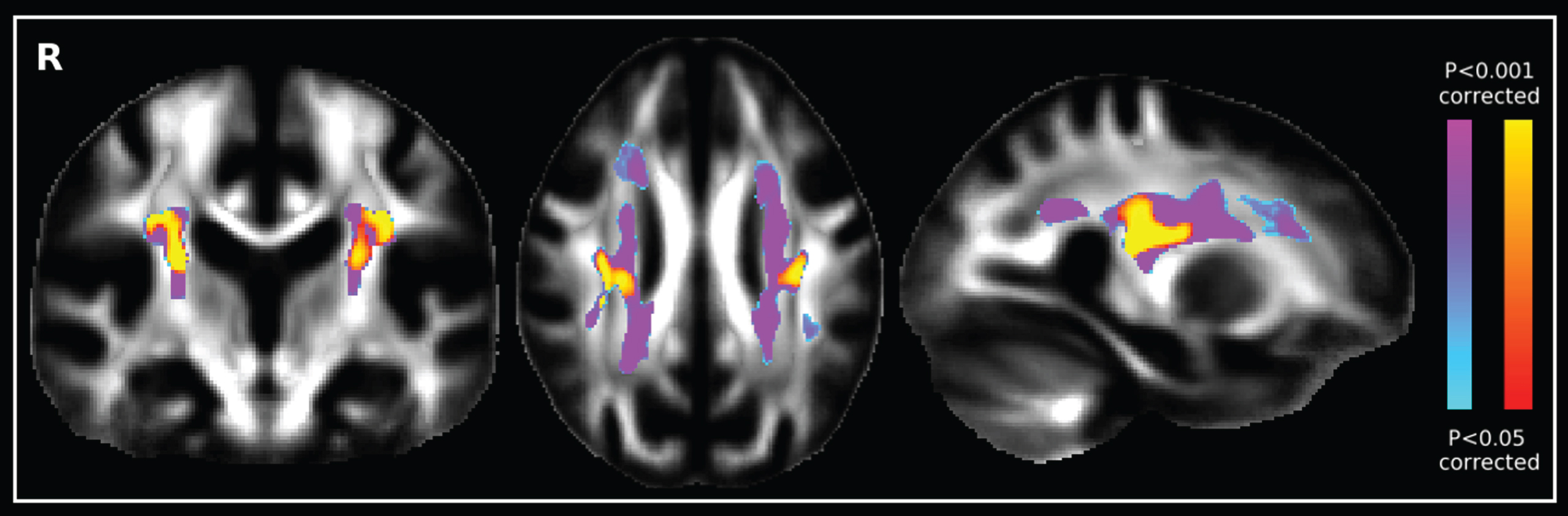 Diffusion tensor image comparing the increase of fractional anisotropy of AD patients (blue-purple scale) with healthy controls (red-yellow scale). Image reprinted with permission from [5].