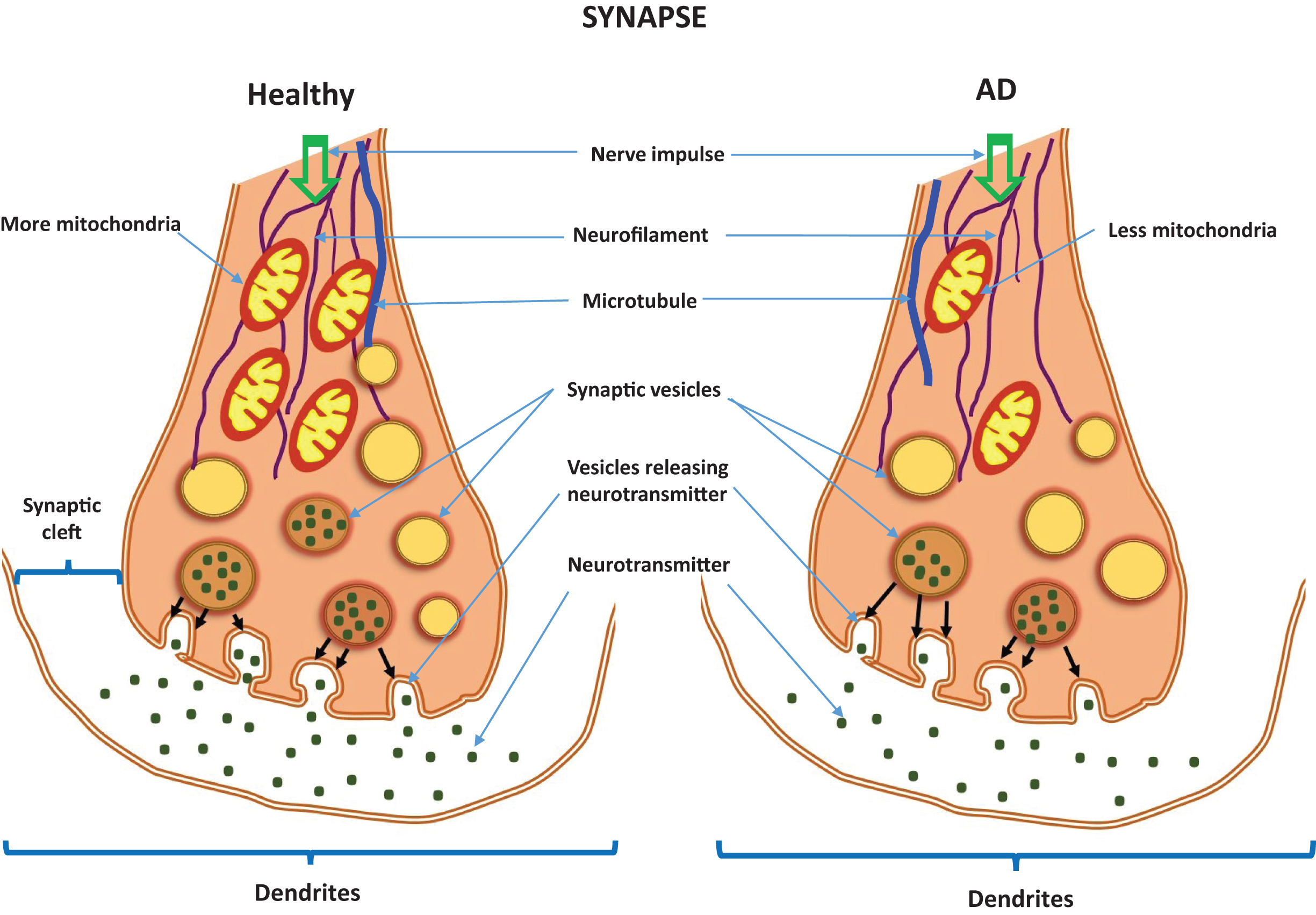 Neurotransmitters in a healthy synapse and an Alzheimer’s disease synapse.