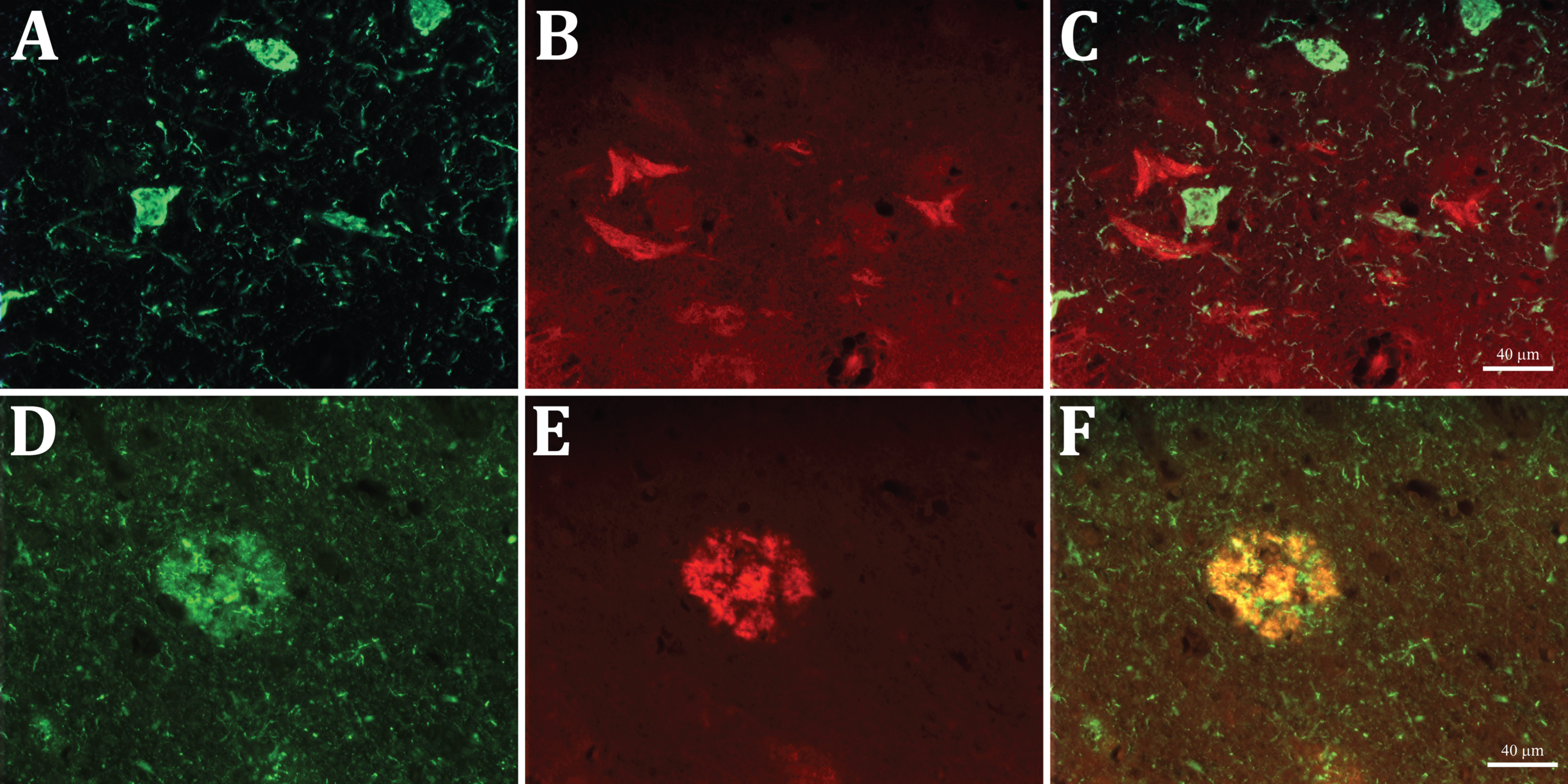 Double immunofluorescent staining with AT8 anti-tau (green, A and D) and anti-Aβx-40 (red, B and E) antibodies in entorhinal cortex sections. Note that the two labels do not co-localize in the NFT profiles nor in the short threads in A and D (merged in C), whereas both co-localize in the senile plaques (merged in F).