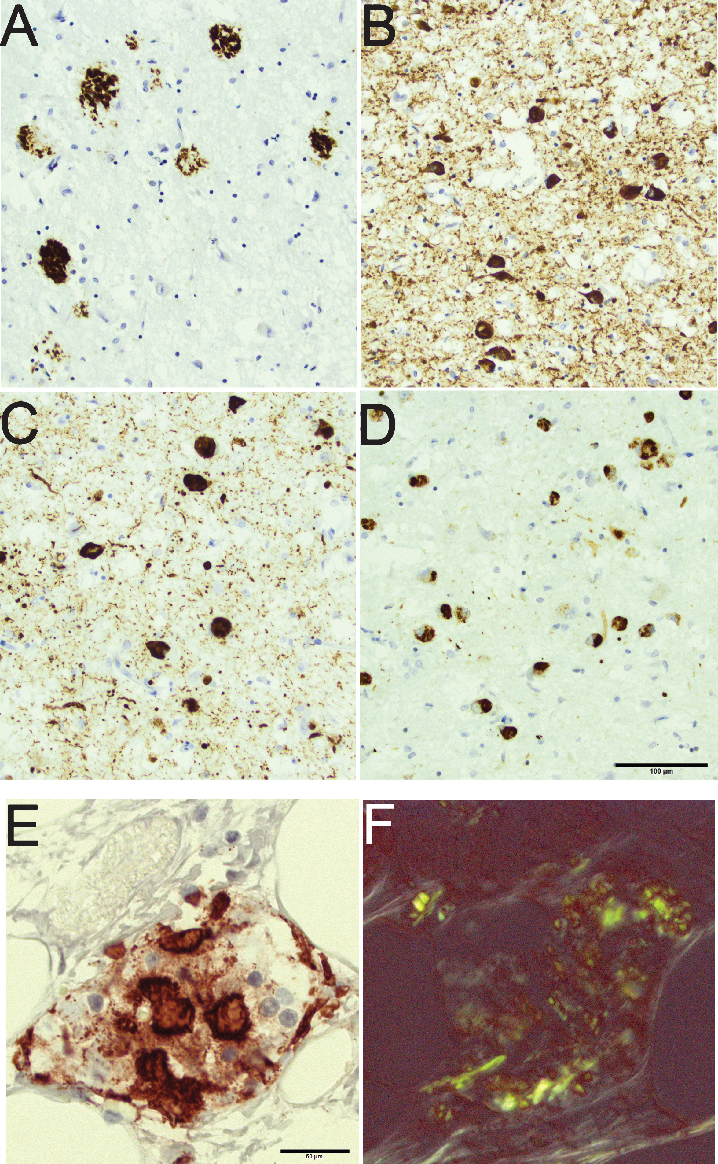An 80-year-old male with a clinical diagnosis of Alzheimer’s disease with mixed pathology seen in the amygdala. Note the rounded amyloid-β labeled aggregates in the brain parenchyma (A), the hyperphosphorylated-τ labeled neurites and intraneuronal tangles (B), the α-synuclein labeled neurites and intraneuronal Lewy bodies (C), and the phosphorylated transactive DNA binding protein 43 labeled cytoplasmic inclusions (D). Pancreas tissue from an 85-year-old female with diabetes mellitus and signs of depression. Note the protein aggregates in an islet of Langerhans labeled with antibody directed to islet amyloid polypeptide (E). The same islet of Langerhans seen in Congo stain (F); note the birefringence of the protein. Scale bar: 100 μm in A-D and 50 μm in E,F.