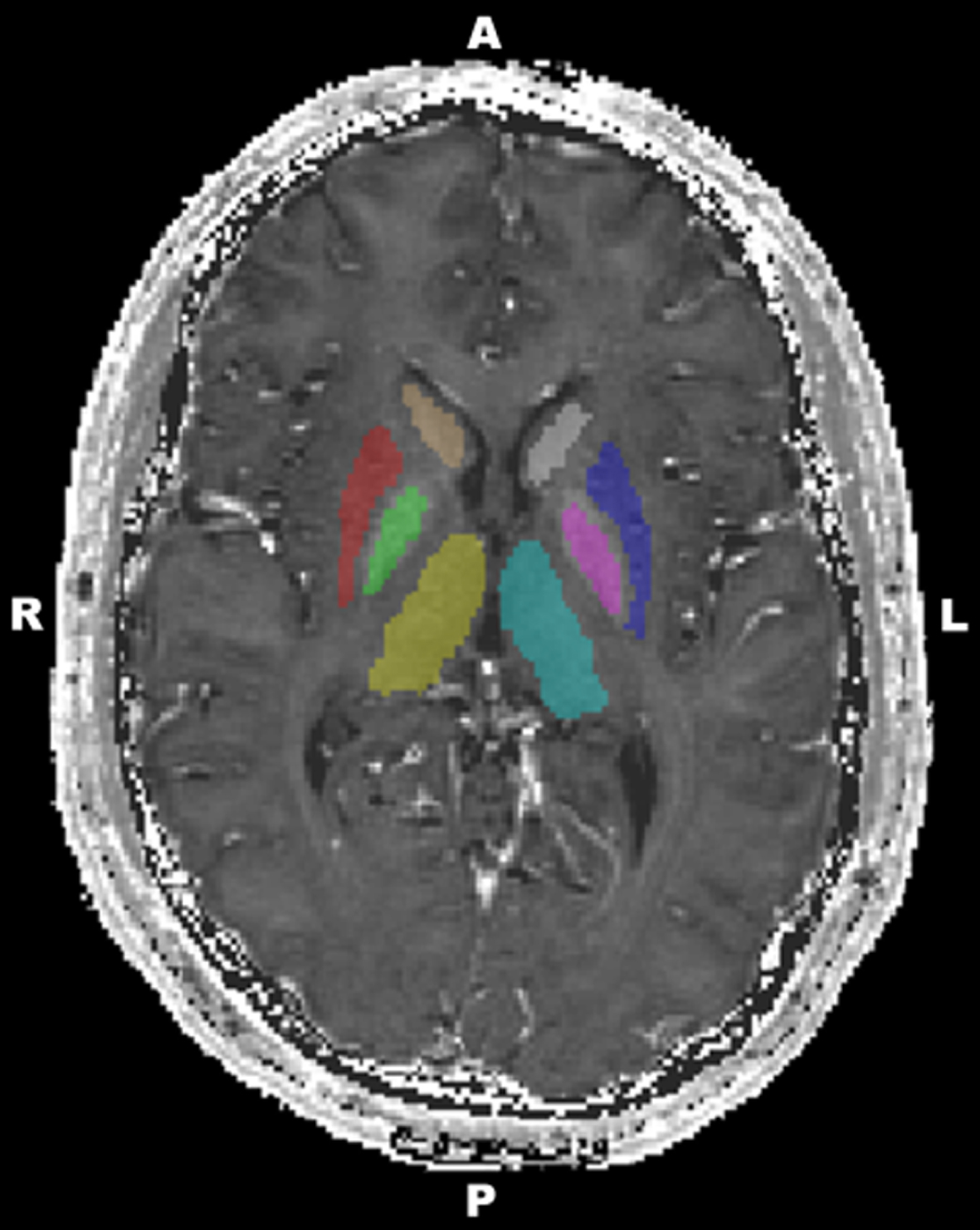 A representative image of deep grey matter structures (cyan, left thalamus; yellow, right thalamus; pink, left globus pallidus; green, right globus pallidus; blue, left putamen; red, right putamen; grey, left caudate; brown, right caudate).