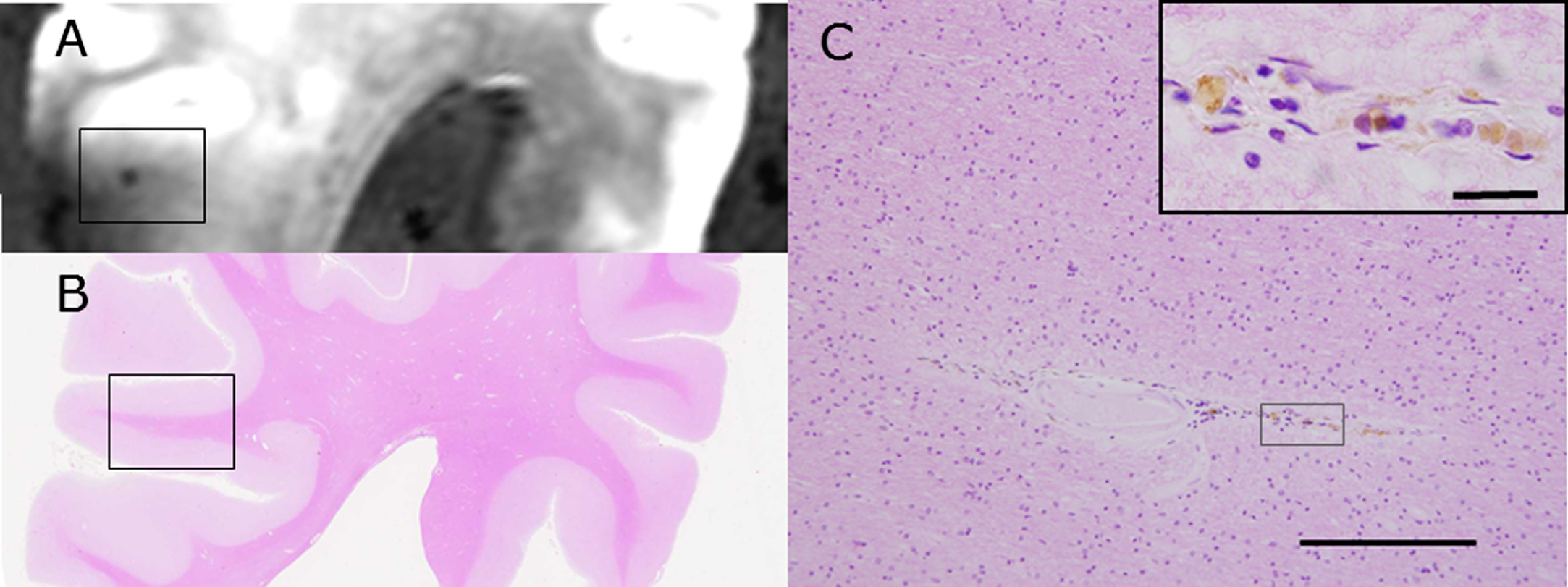 A CMB detected with SWI with postmortem 3T MRI (A) is compared with HE staining of the brain block (B) of subject C1. The rectangle in B is enlarged in C and shows accumulation of hemosiderin-laden macrophages around the small vessels (Inset). Scale bars in C: 200 μm (inset: 20 μm).